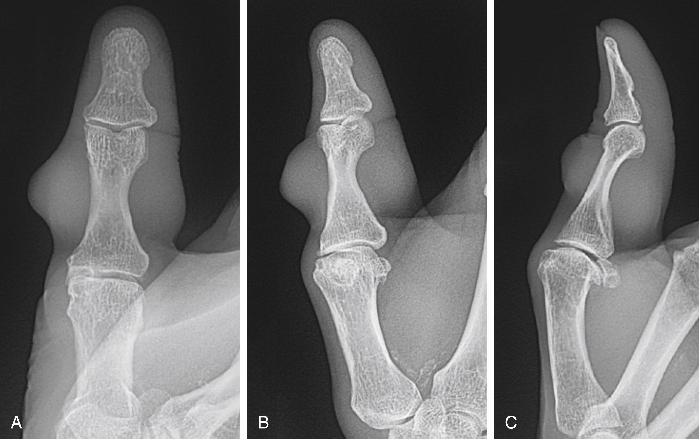 Fig. 60.2, (A–C) Plain X-rays of thumb soft tissue mass demonstrating distortion of proximal phalanx from slow growth, but no bony erosion.