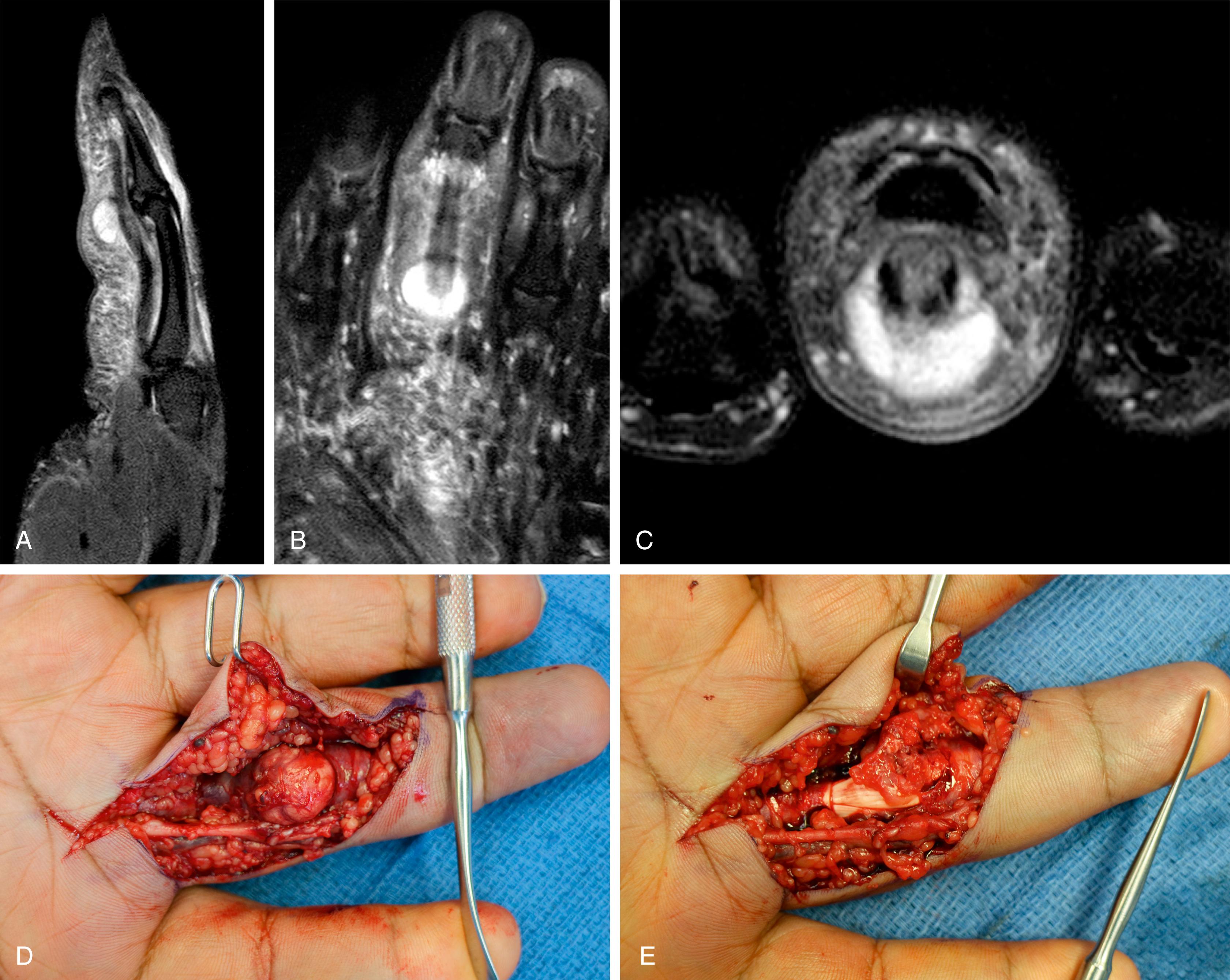 Fig. 60.3, (A–C) MRI of a patient presenting with a painful volar finger mass, demonstrating a fluid-filled lesion of the tendon sheath. On exploration, the lesion was found to be (D) a gouty tophus, with (E) direct invasion into the flexor tendons.