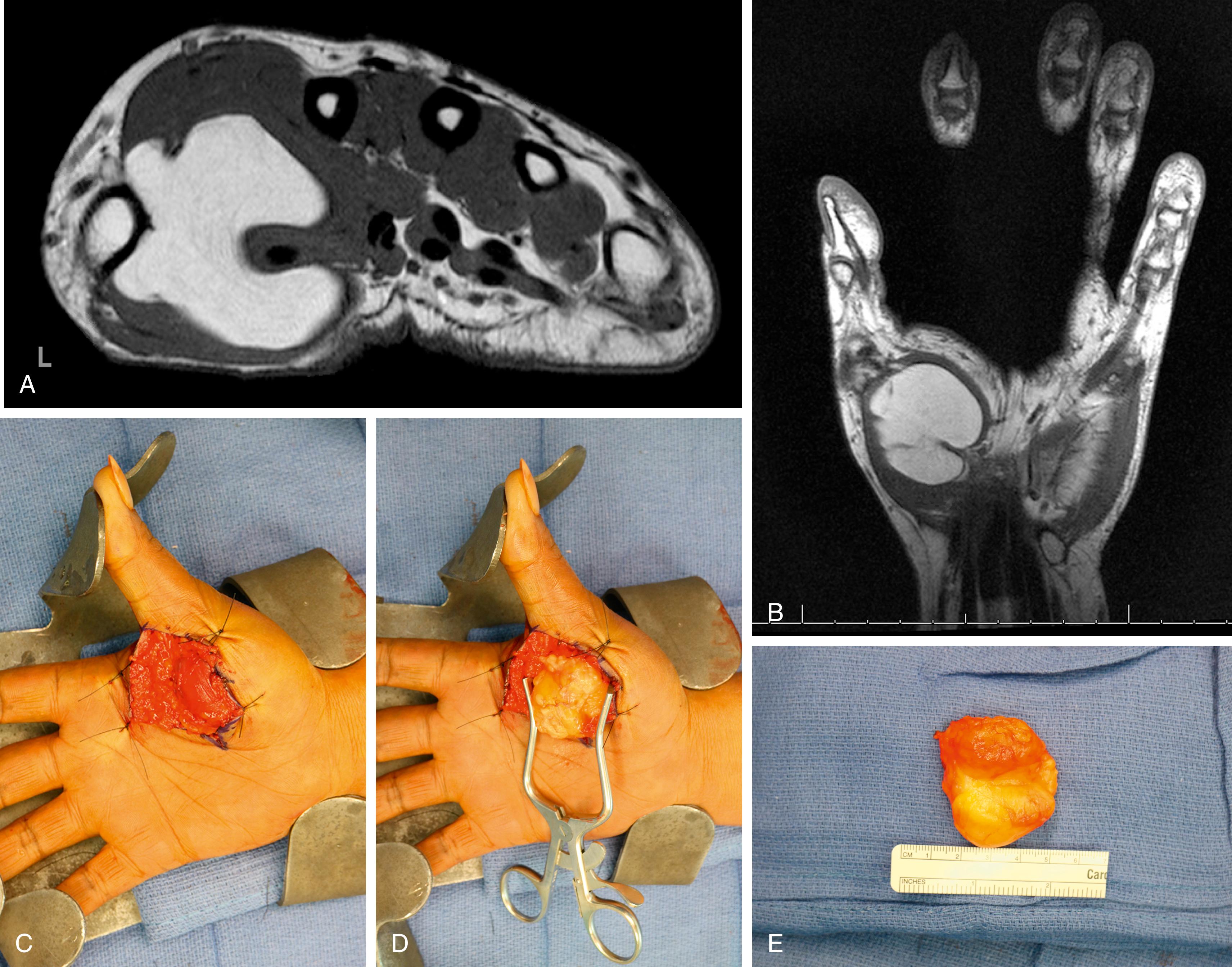 Fig. 60.4, (A,B) MRI of a patient with a significant thenar mass demonstrating a lipoma within the thenar compartment. (C–E) A well-encapsulated lipoma was removed by direct excision.