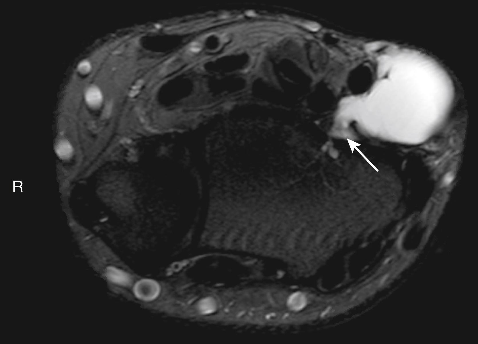 Fig. 60.6, MRI of volar wrist ganglion in close proximity to radial artery and stalk extending to radial carpal joint ( arrow ).