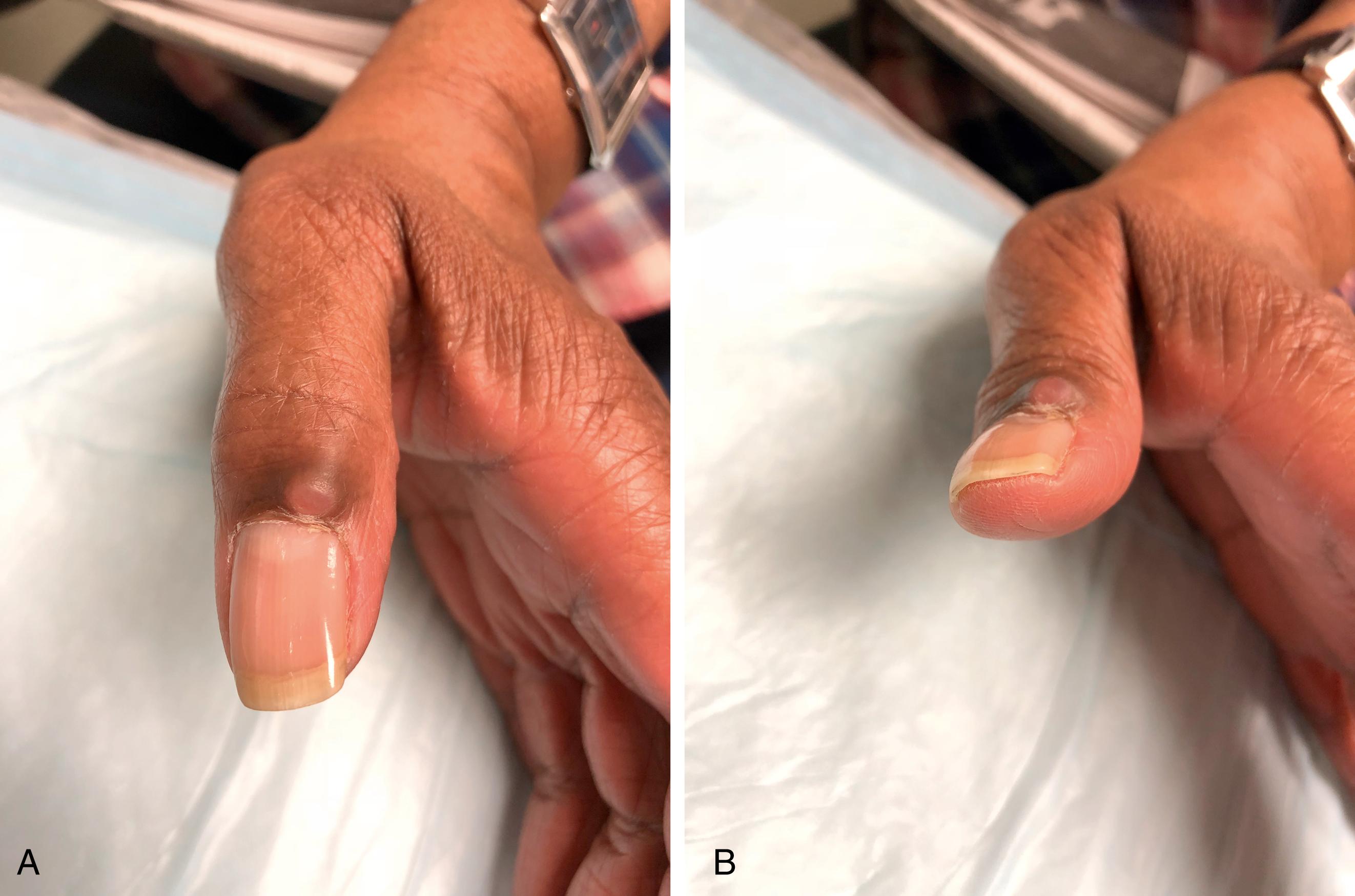 Fig. 60.7, (A) Mucous cyst of thumb proximal to nail fold. Note thinning of skin overlying the cyst. (B) Pressure on the germinal matrix resulted in flattening of the nail distal to the cyst.