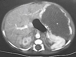 Fig. 66.2, CT scan after intravenous administration of a contrast agent shows a large hemangioendothelioma (asterisk) with peripheral enhancement in the left lateral segment.