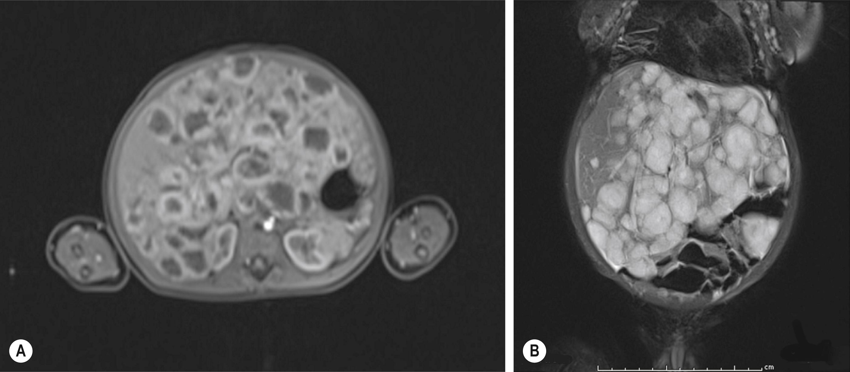 Fig. 66.3, Infantile hepatic hemangioma: diffuse form. (A) An MRI in the arterial phase showing rim enhancement of the hemangiomas after injection with gadoxetate disodium (Eovist). (B) The T2-weighted image showing the same liver that is filled with hemangiomas.