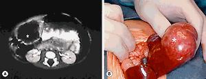 Fig. 66.4, This young child presented with a palpable right upper abdominal mass. (A) CT scan shows an anechoic mass (asterisk) in the periphery of the liver. (B) At operation, the mass (asterisk) was found to be pedunculated and emanating from the right lobe of the liver. This hamartoma was easily removed.