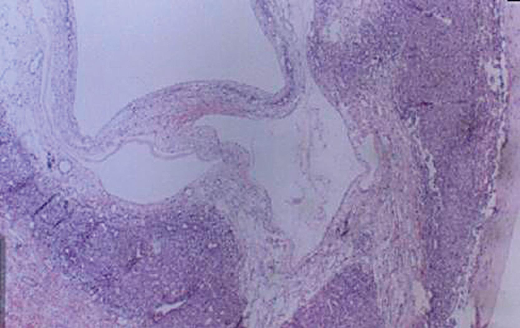 Fig. 66.6, Light microscopy of a mesenchymal hamartoma showing a cyst lined with cuboidal epithelium.