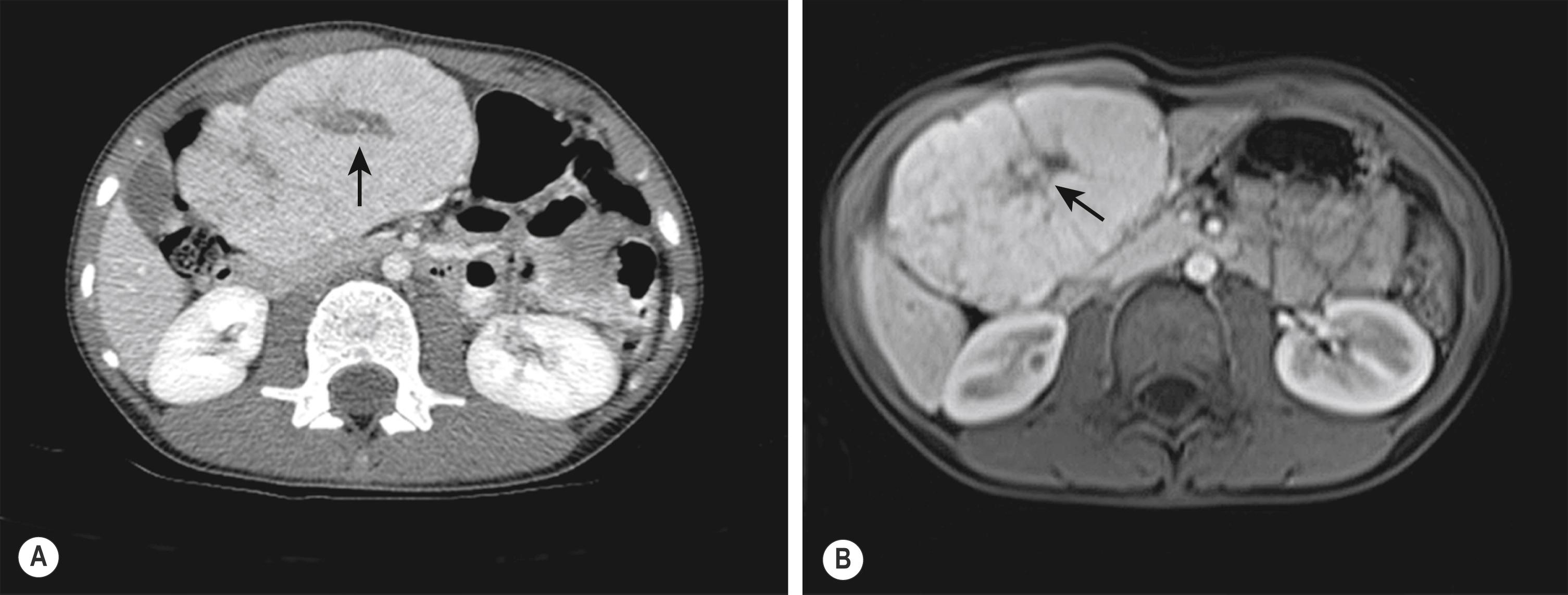 Fig. 66.7, CT scan after intravenous administration of contrast agent (A) and MRI with hepatocyte phase contrast (Eovist, T1, fat saturated) (B) show an early enhancing lesion in the right lobe with a hypodense central scar (arrows) consistent with focal nodular hyperplasia.