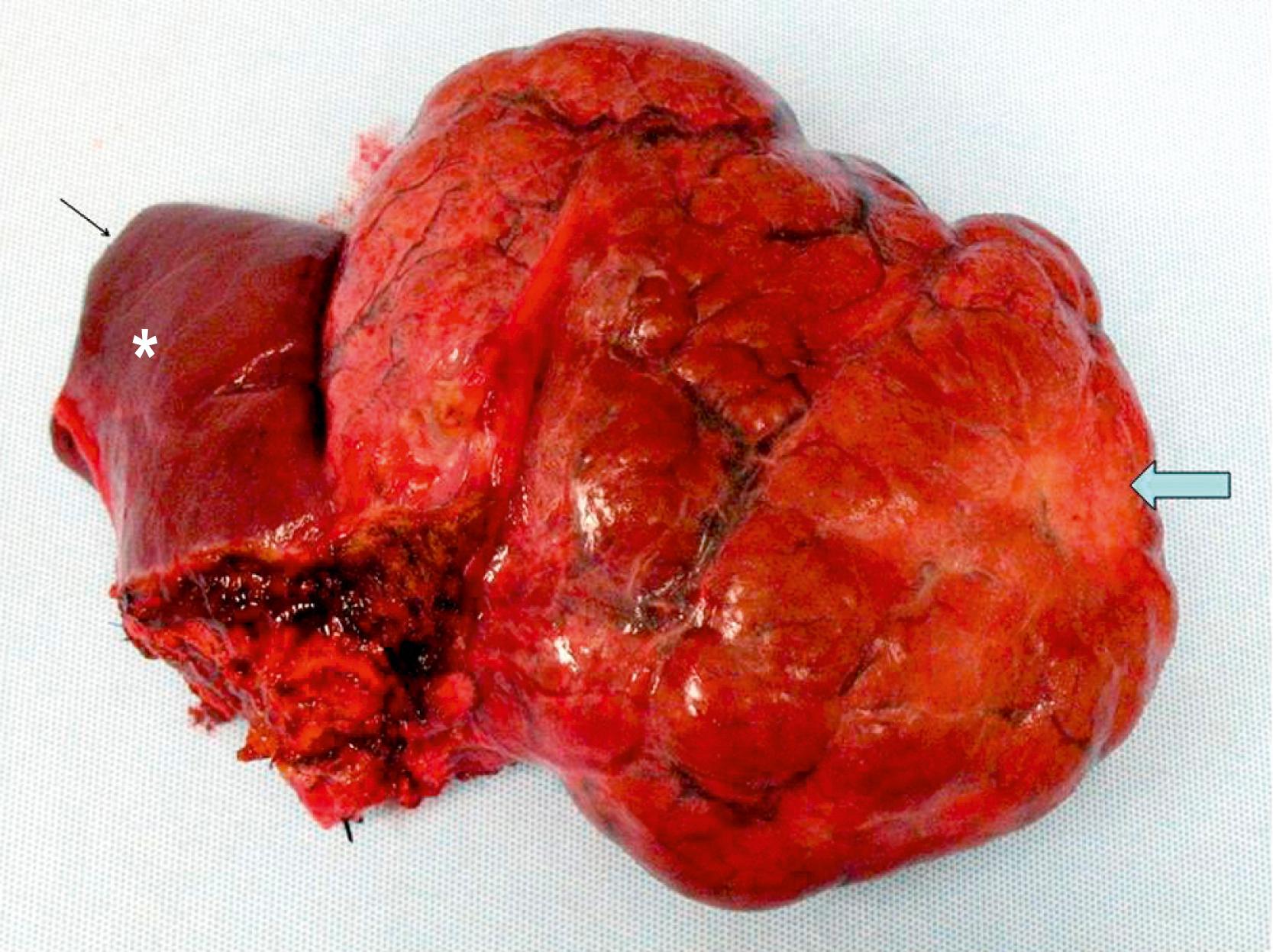 Fig. 66.8, A large focal nodular hyperplasia lesion was resected. External scarring (arrow) is seen in the lesion. An asterisk marks normal liver.