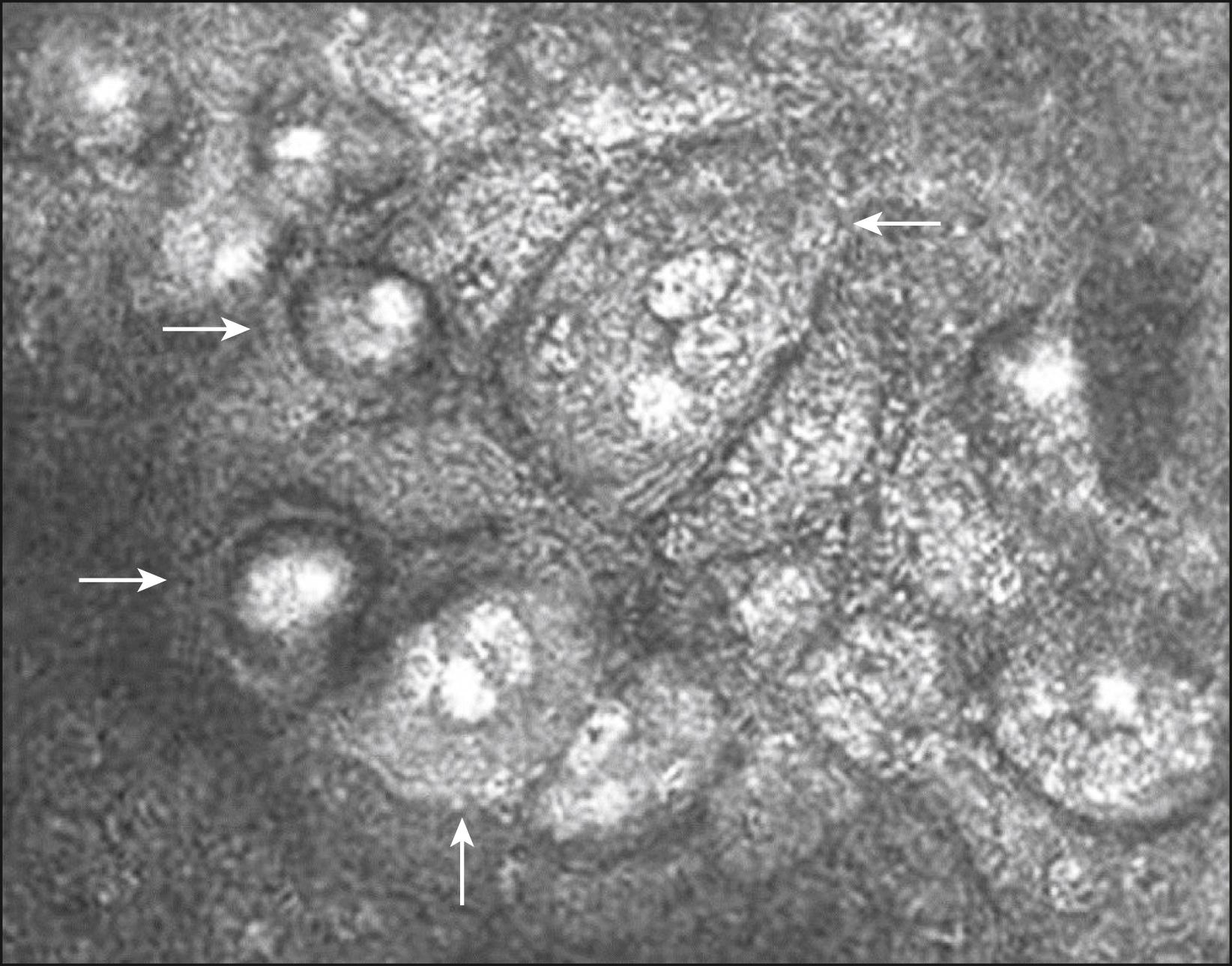 Fig. 80.2, In vivo confocal microscopy is shown at the level of the corneal endothelium in a patient with polymerase chain reaction (PCR)-proven cytomegalovirus endotheliitis. Large cells are observed, which appear to have an owl’s eye morphology (white arrows) .