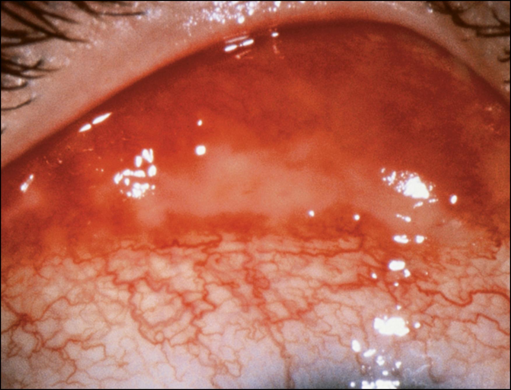 Fig. 80.3, Epstein-Barr virus–associated conjunctival nodule.