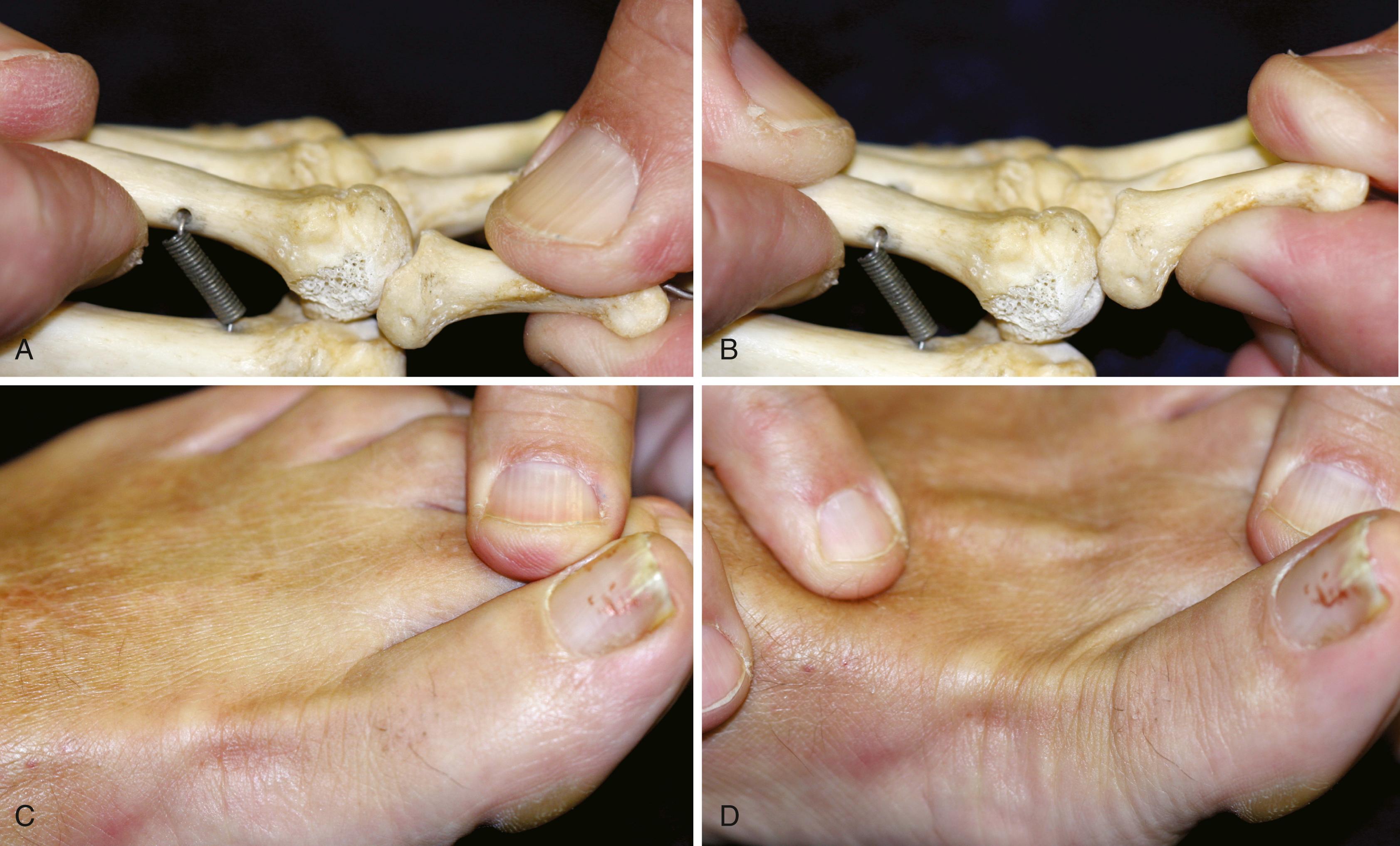 FIGURE 84.1, Lachman test of metatarsophalangeal joint stability. A, Starting position. B, Positive Lachman test of metatarsophalangeal joint. C, Starting position for examination. D, Positive test with visible and palpable subluxation of joint.