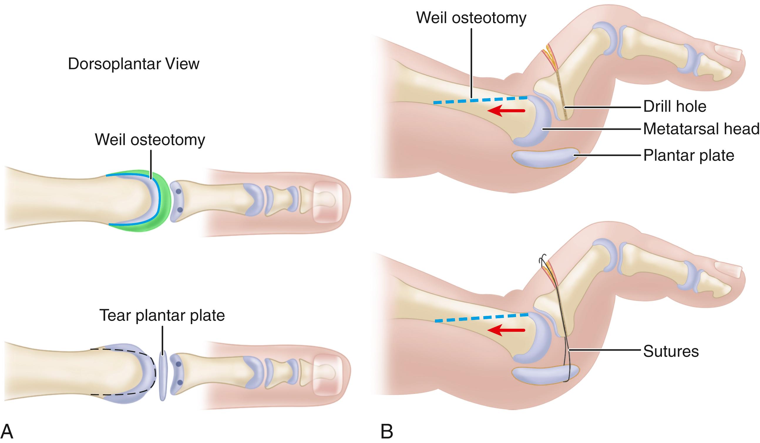 FIGURE 84.11, A and B, Primary plantar plate repair for metatarsophalangeal joint instability. SEE TECHNIQUE 84.2 .