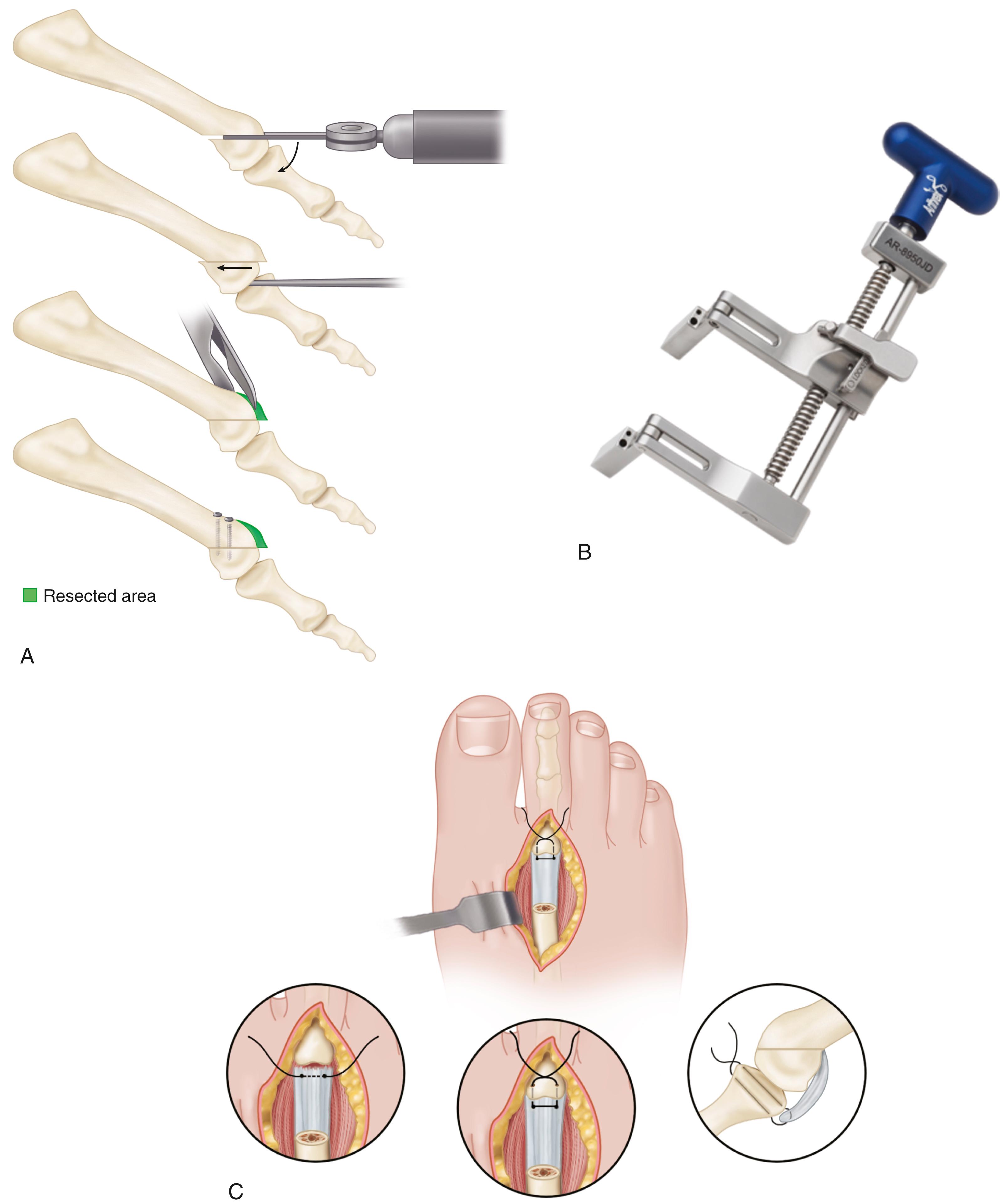 FIGURE 84.12, Primary plantar plate repair through dorsal approach. A, Weil osteotomy. B, Miniature joint distractor (Arthrex, Inc., Naples, FL). C, Fixation of plantar plate to its insertion point at plantar base of phalanx. SEE TECHNIQUE 84.2 .