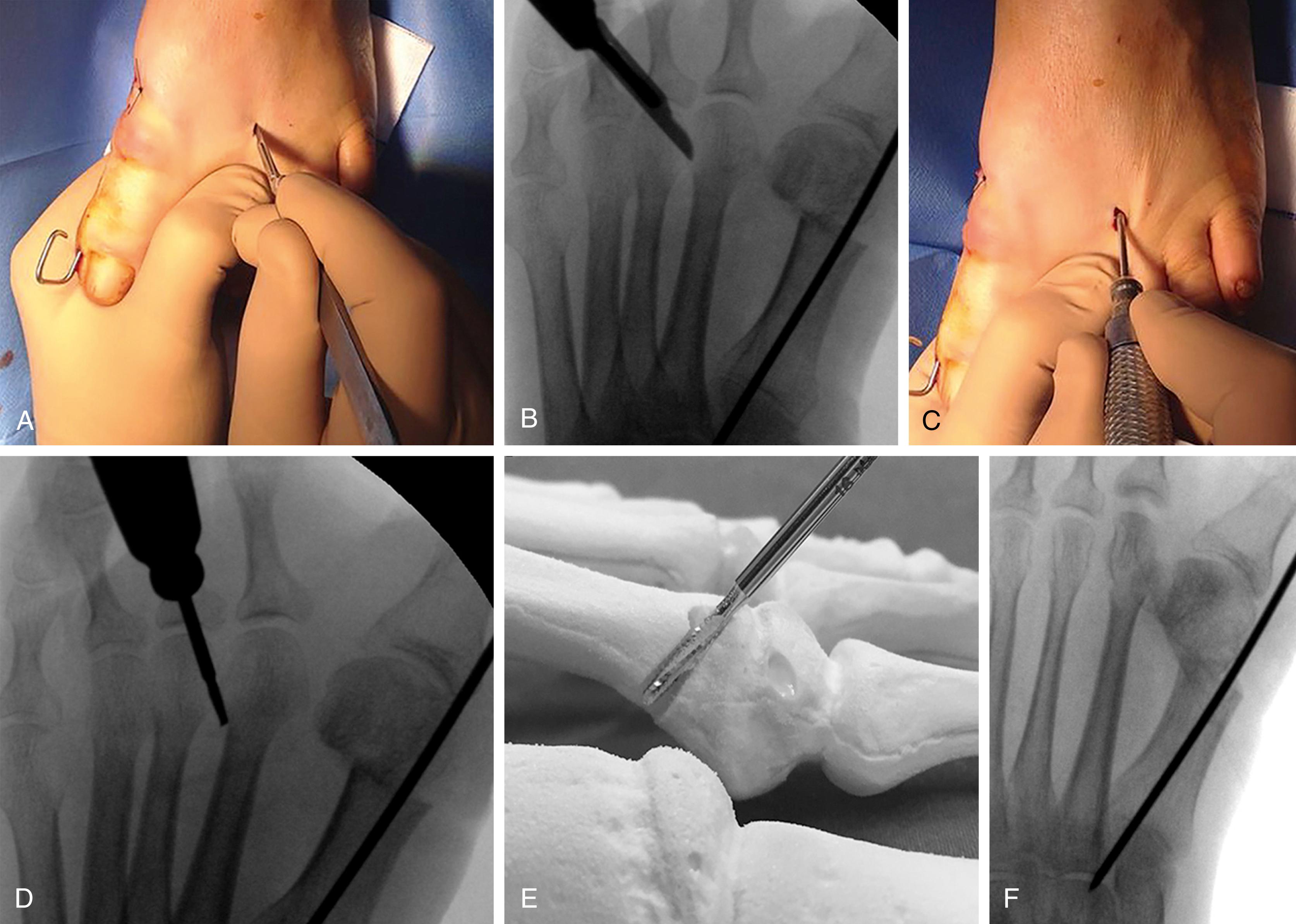 FIGURE 84.13, Percutaneous distal osteotomy of the lesser metatarsals. A and B , Incision. C-E , Osteotomy performed with micromotorized bone-cutter. F , Completion of osteotomy confirmed fluoroscopically. (From Magnan B, Bonetti I, Negri S, et al: Percutaneous distal osteotomy of lesser metatarsals (DMMO) for treatment of metatarsalgia with metatarsophalangeal instability, Foot Ankle Surg 24:400, 2018.) SEE TECHNIQUE 84.3 .