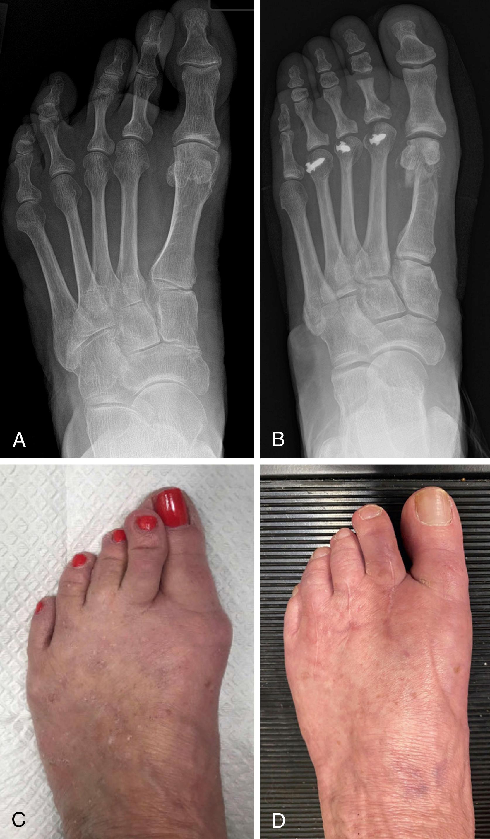 FIGURE 84.14, Weil osteotomy. A, Preoperative views showing varus deformity of second through fourth metatarsophalangeal joints. B, Correction with medializing Weil osteotomies and medial collateral ligament releases. C and D, Preoperative and postoperative clinical photographs after Weil osteotomy. SEE TECHNIQUE 84.4 .