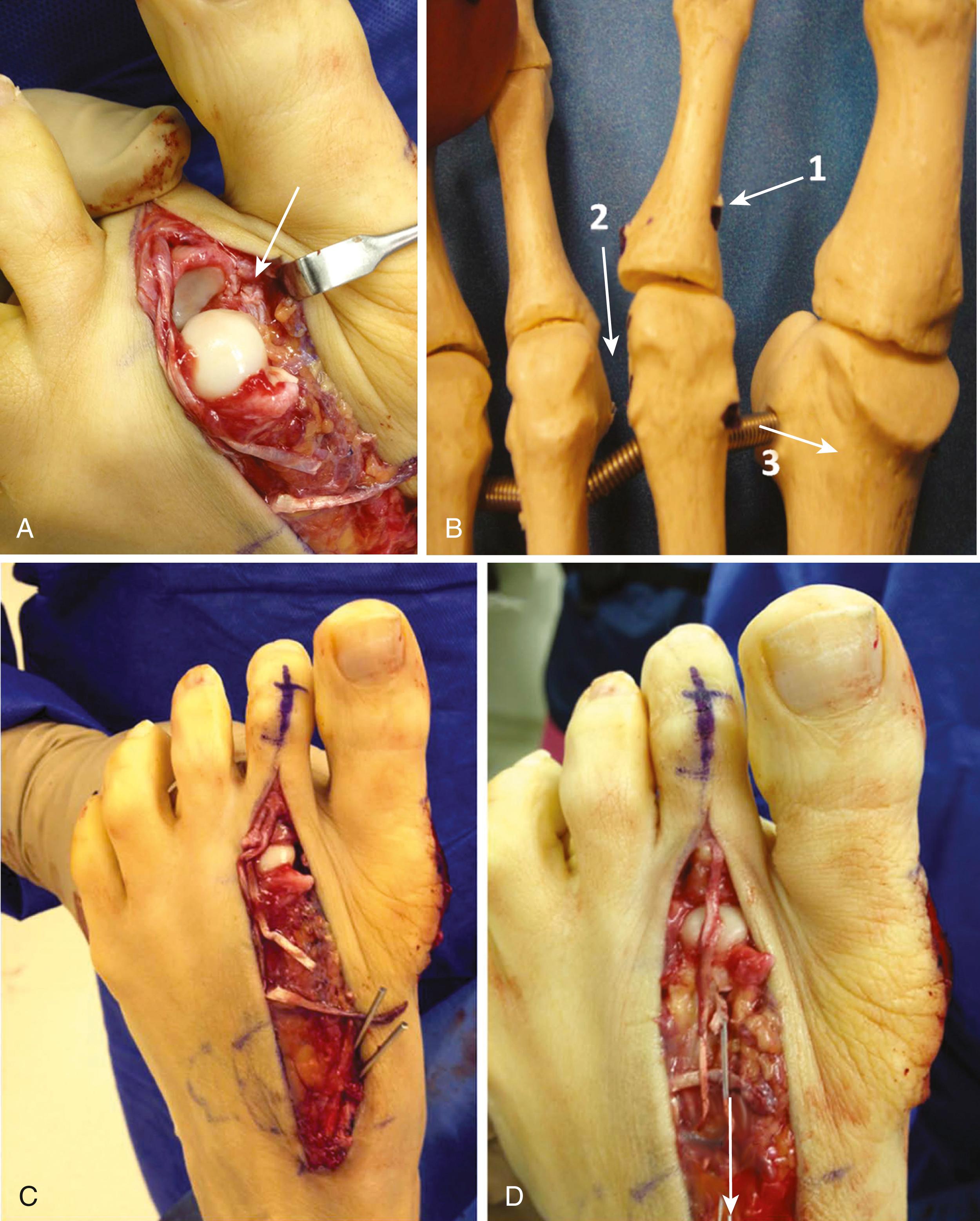 FIGURE 84.15, Metatarsophalangeal release and extensor brevis reconstruction. A, Second metatarsophalangeal joint after plantar plate release (arrow), but before extensor digitorum brevis reconstruction. B, Path of extensor digitorum brevis tendon: through proximal phalanx (1), under soft tissue dorsal to transverse ligament on lateral side of joint (2), and through neck of second metatarsal (3). C, Extensor digitorum brevis tendon has been passed through proximal phalanx and metatarsal. Position of toe before ( C ) and after ( D ) tensioning shows correction of second toe varus. D, Arrow below nonabsorbable suture shows vector of tensioning used before reconstruction is secured to screw post in metatarsal shaft. (From Ellis SJ, Young EM, Endo Y, et al: Correction of multiplanar deformity of the second toe with metatarsophalangeal release and extensor brevis reconstruction, Foot Ankle Int 34:792, 2013.) SEE TECHNIQUE 84.5 .