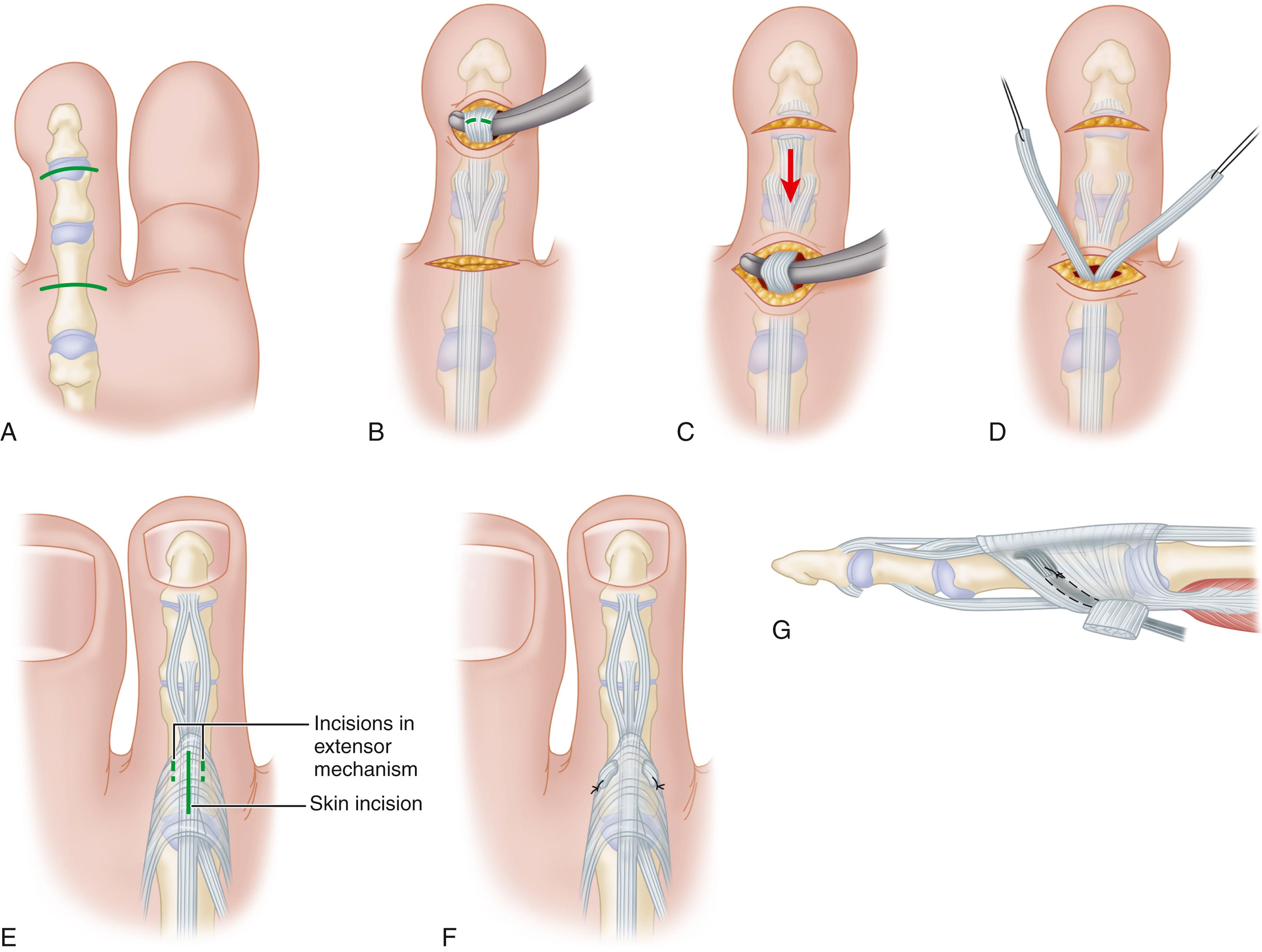 FIGURE 84.16, A-G, Flexor-to-extensor tendon transfer to dorsum of second toe. SEE TECHNIQUE 84.6 .