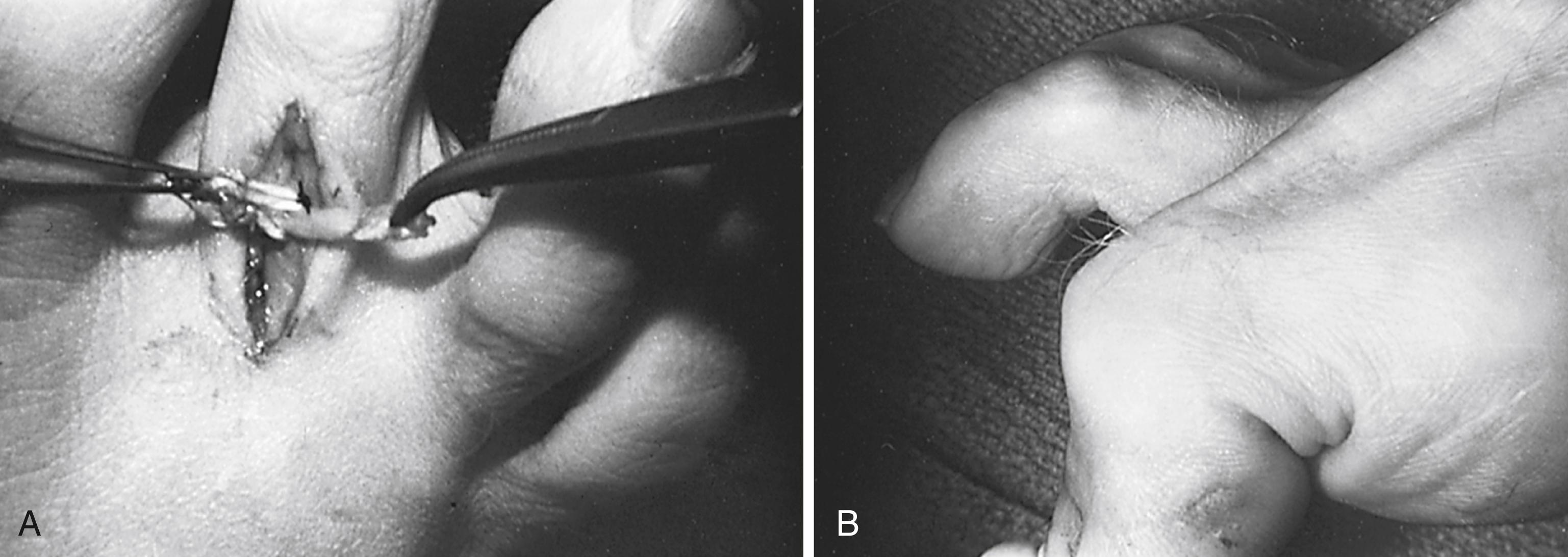 FIGURE 84.17, Flexible hammer toe. A, During transfer of flexor to extensor tendon. B, After surgery. Note small knot beneath skin. SEE TECHNIQUE 84.6 .