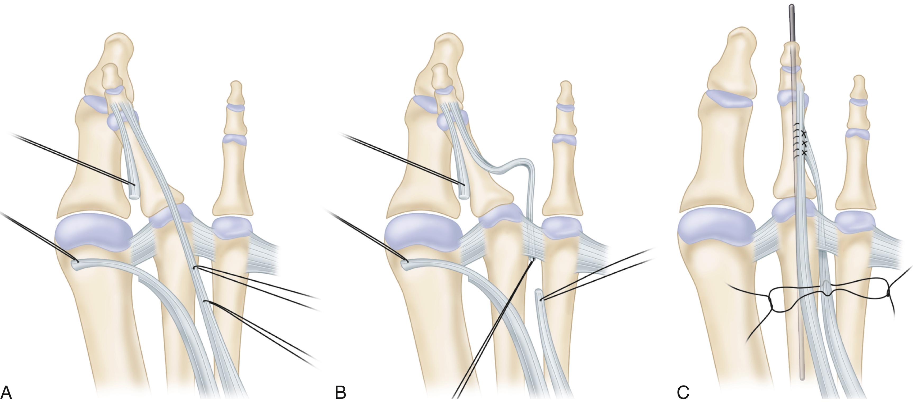 FIGURE 84.18, A-C, Extensor digitorum brevis transfer for crossover toe deformity. SEE TECHNIQUE 84.7 .