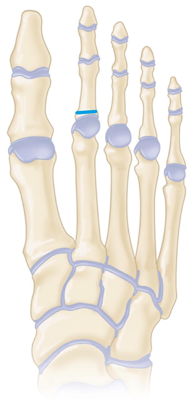 FIGURE 84.19, Closing wedge osteotomy of proximal phalanx for correction of axial deformity. SEE TECHNIQUE 84.8 .