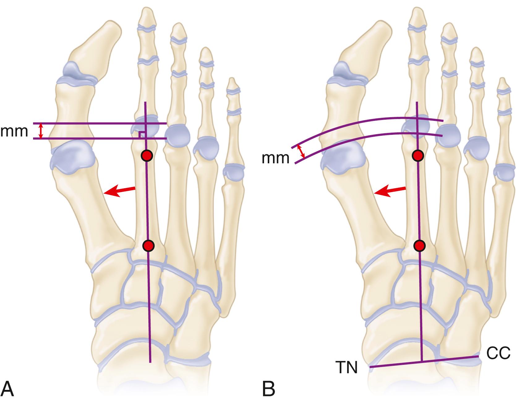 FIGURE 84.2, Measurement of metatarsal length according to the methods of Morton (A) and Hardy and Clapham (B) . CC, Calcaneocuboid joint; TN, talonavicular joint.