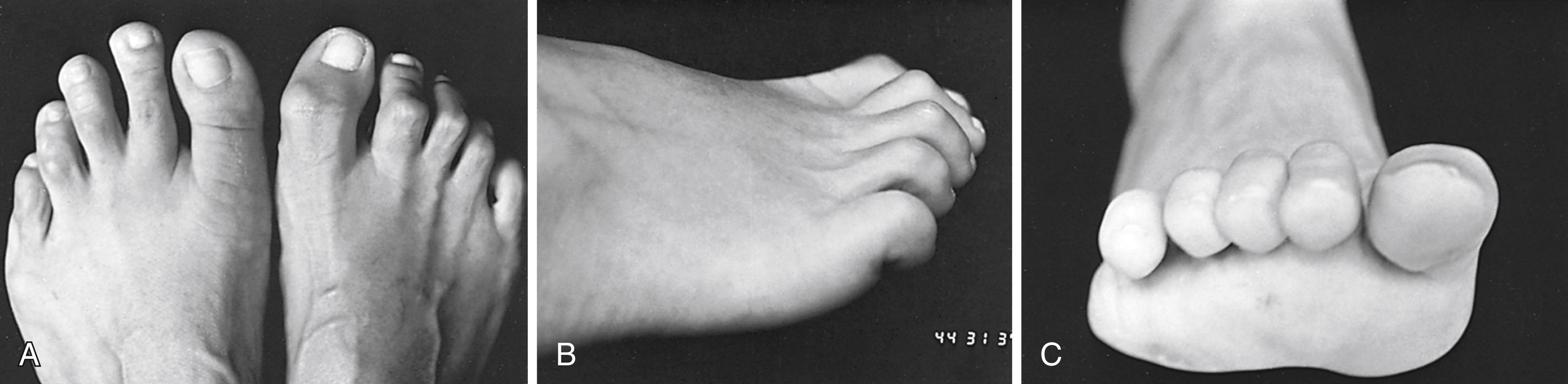 FIGURE 84.21, A, Claw toes, right foot, secondary to medial and lateral plantar nerve laceration. B, Metatarsophalangeal joints of second and third toes could not be flexed to neutral position, and none could be flexed past neutral. C, Extension posture of claw toes increases plantar pressure on metatarsal heads.