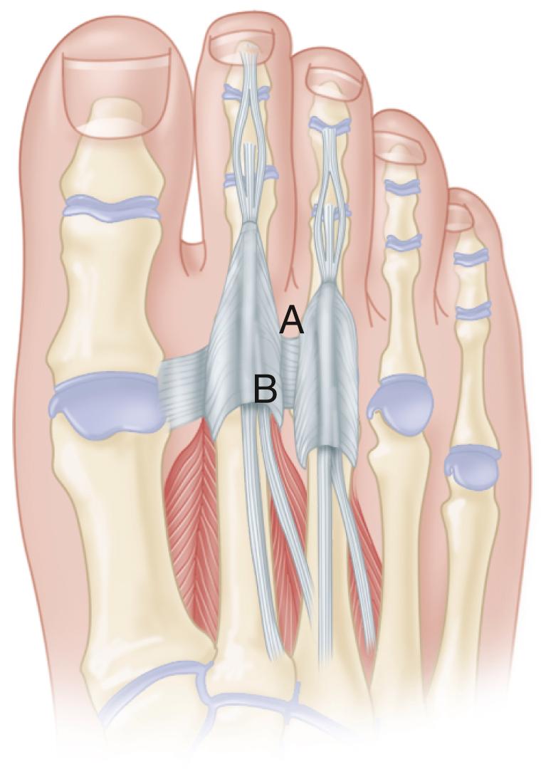 FIGURE 84.22, Site of tenderness with interdigital neuroma of second web space (A). Site of tenderness in idiopathic synovitis of second metatarsophalangeal joint: dorsofibular capsule and fibular collateral ligament (B).