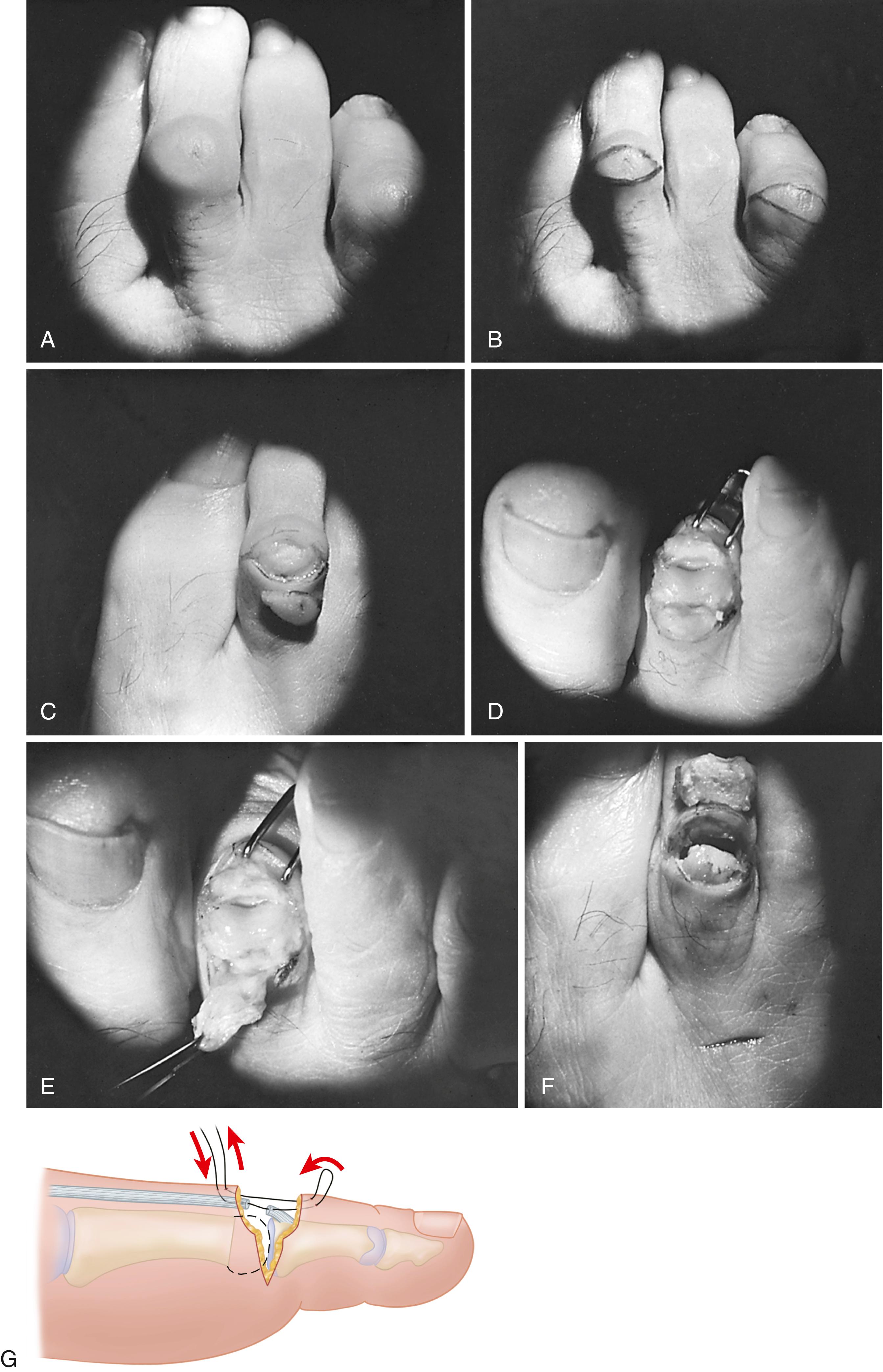 FIGURE 84.23, A, Moderate hammer toe deformity with fixed contracture at proximal interphalangeal joint but only extensor tightness at metatarsophalangeal joint with no fixed extension contracture. B, Dorsal elliptical incision over proximal interphalangeal joint. C, Superficial dissection leaving dorsal veins visible to make cauterization easier. D, Dorsal capsule, both collateral ligaments, and extensor tendon are sectioned transversely, and toe is acutely flexed. E, Extensor tendon is dissected proximally to junction of middle and distal thirds of proximal phalanx. F, Distal 25% to 30% of proximal phalanx is excised and rests on middle phalanx. Small dorsal incision for extensor tenotomy. G, Closure of wound. SEE TECHNIQUE 84.9 .