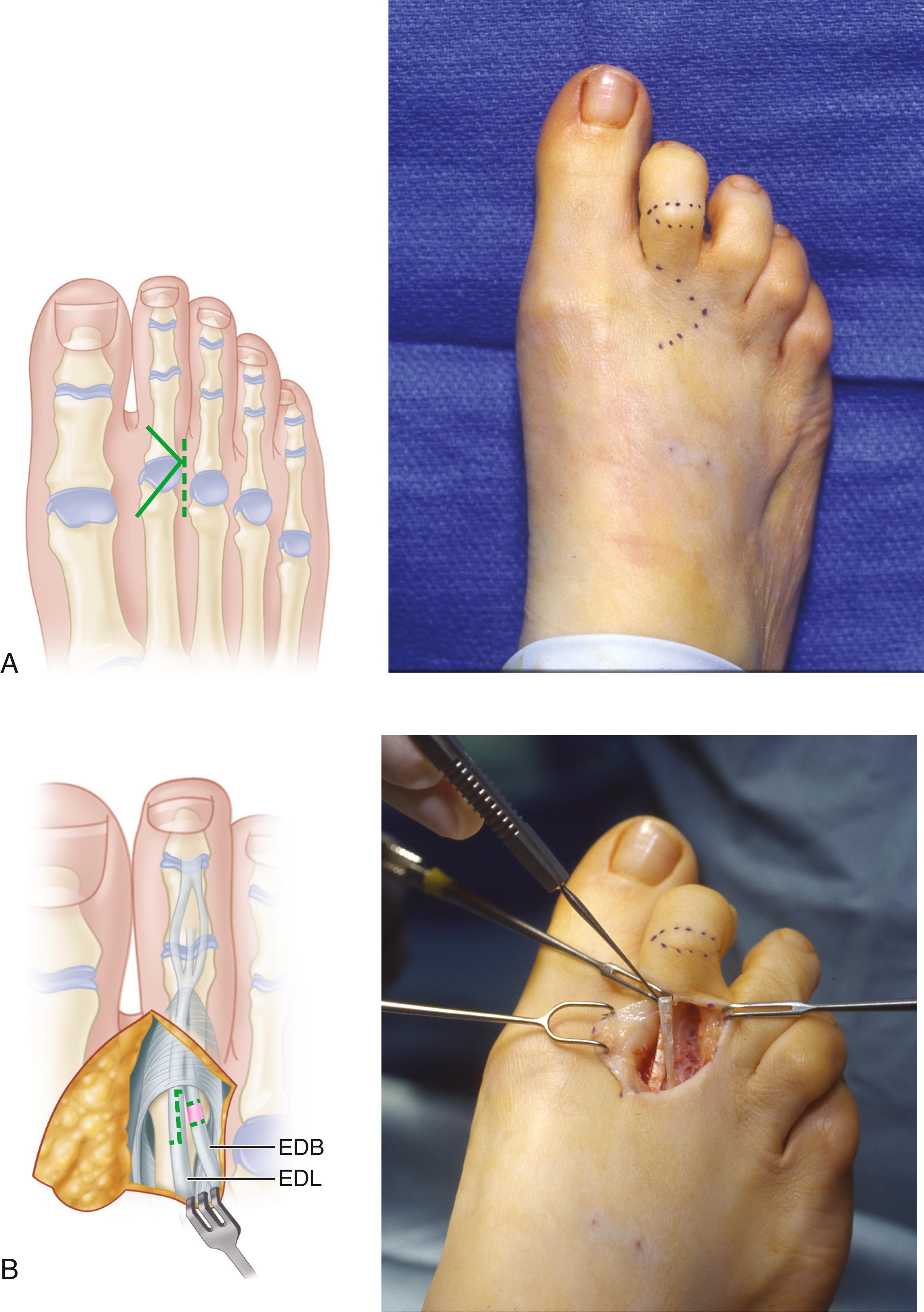 FIGURE 84.26, A-D, Technique for correction of severe hammer toe deformity. EDB, extensor digitorum brevis; EDL, extensor digitorum longus. SEE TECHNIQUE 84.10 .