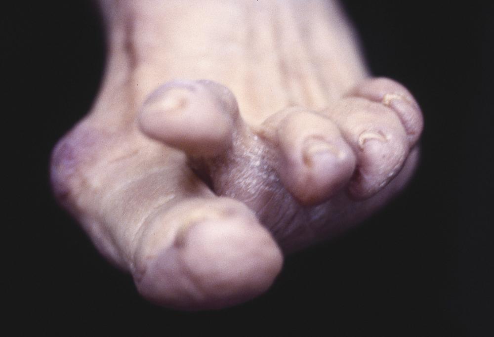 FIGURE 84.25, Severe crossover hammer toe deformity. SEE TECHNIQUE 84.10 .