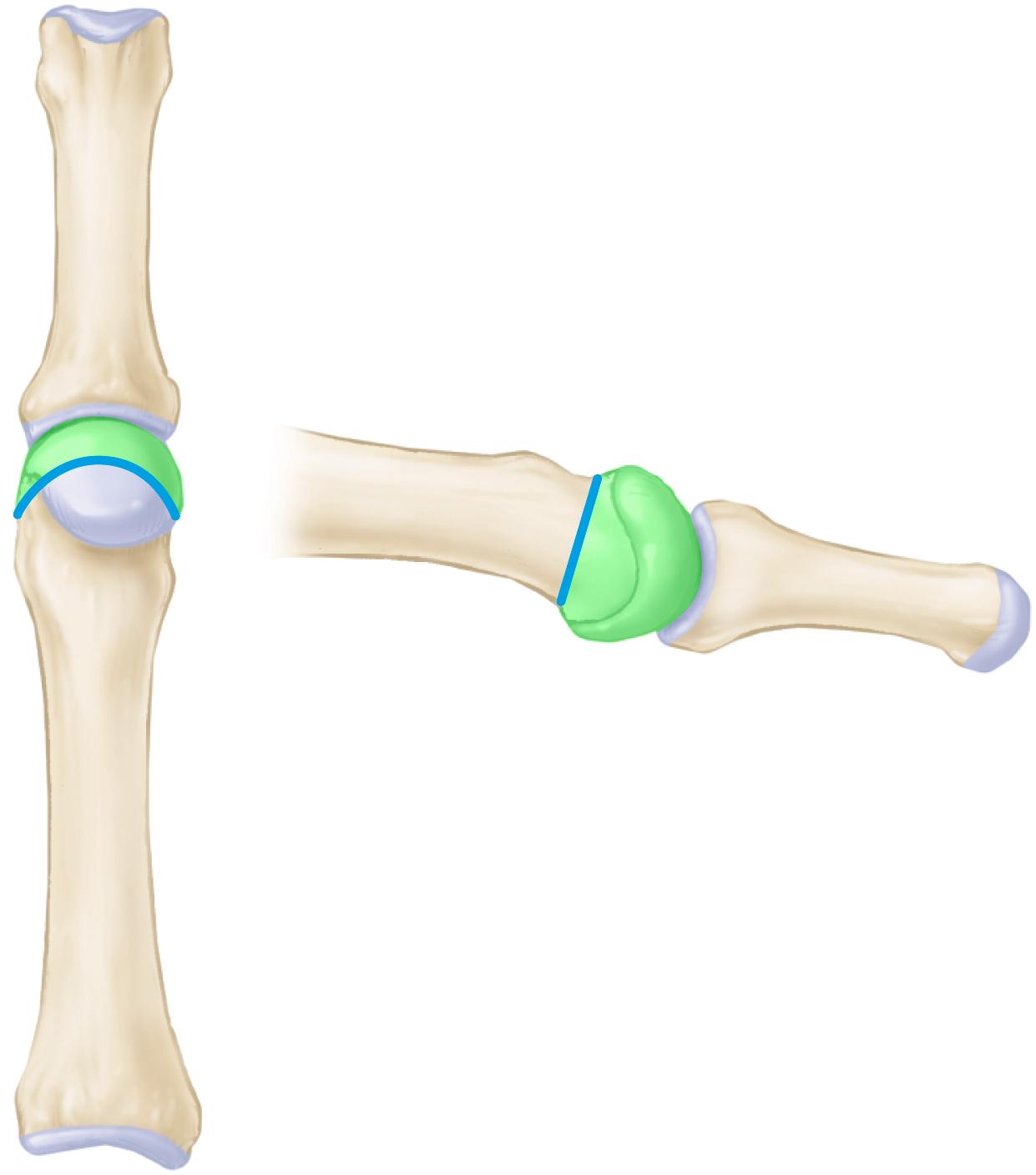 FIGURE 84.27, Resection (contouring) of metatarsal head for correction of severe hammer toe deformity with dislocation of metatarsophalangeal joint. SEE TECHNIQUE 84.11 .