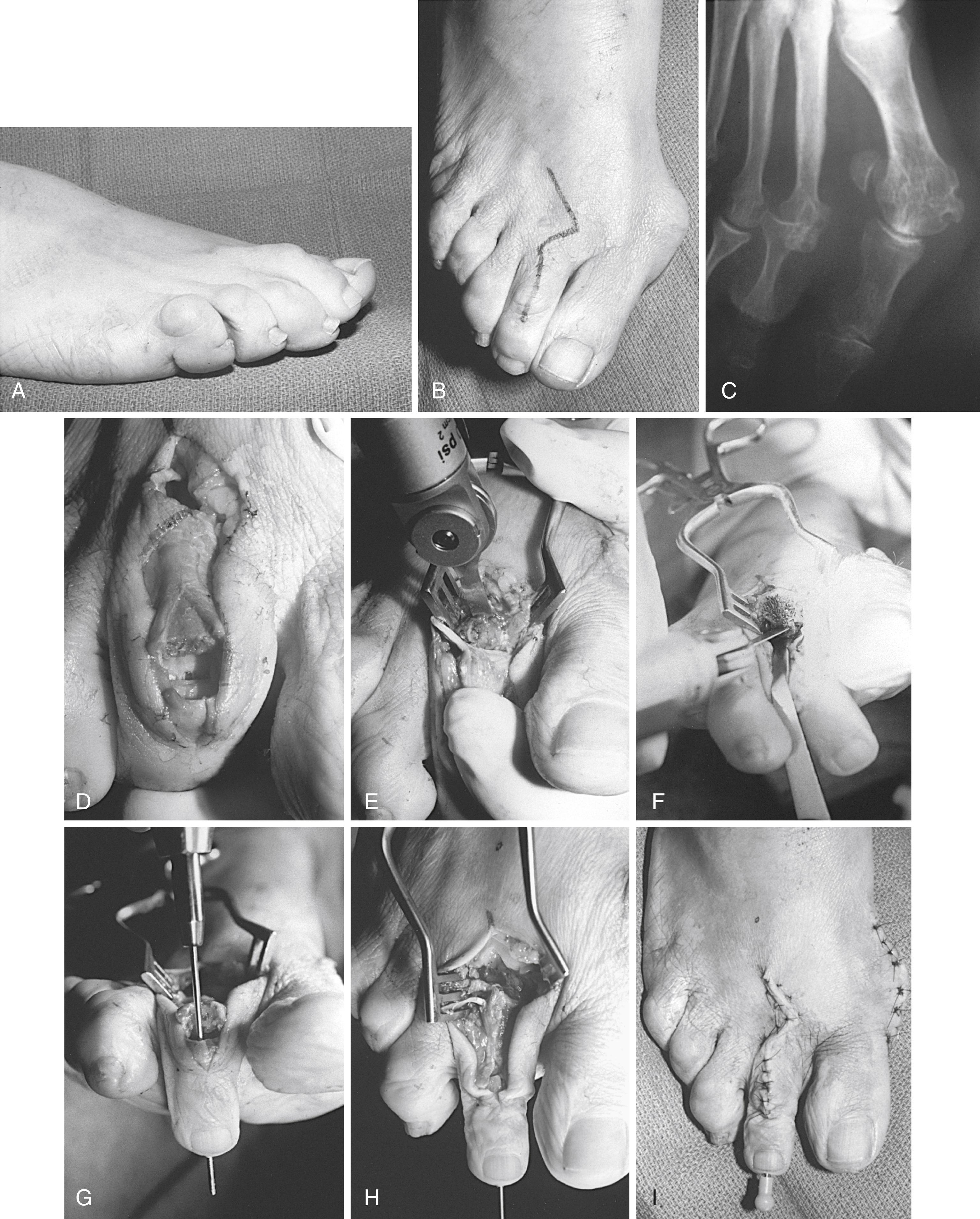 FIGURE 84.28, Reconstruction for severe hammer toe deformity with dislocation of metatarsophalangeal joint. A and B, Clinical appearance and planned operative incision. C, Radiographic evaluation of dislocation. D, After resection of proximal phalanx, dorsal capsulotomy at metatarsophalangeal joint, and extensor tendon lengthening. E, Resection of distal portion of metatarsal head. F, Plantar condylectomy of metatarsal head. G, Antegrade pinning through proximal interphalangeal joint with 0.045-inch Kirschner wire. H, Retrograde pinning through proximal phalanx across metatarsophalangeal joint. I, Postoperative appearance. SEE TECHNIQUE 84.11 .