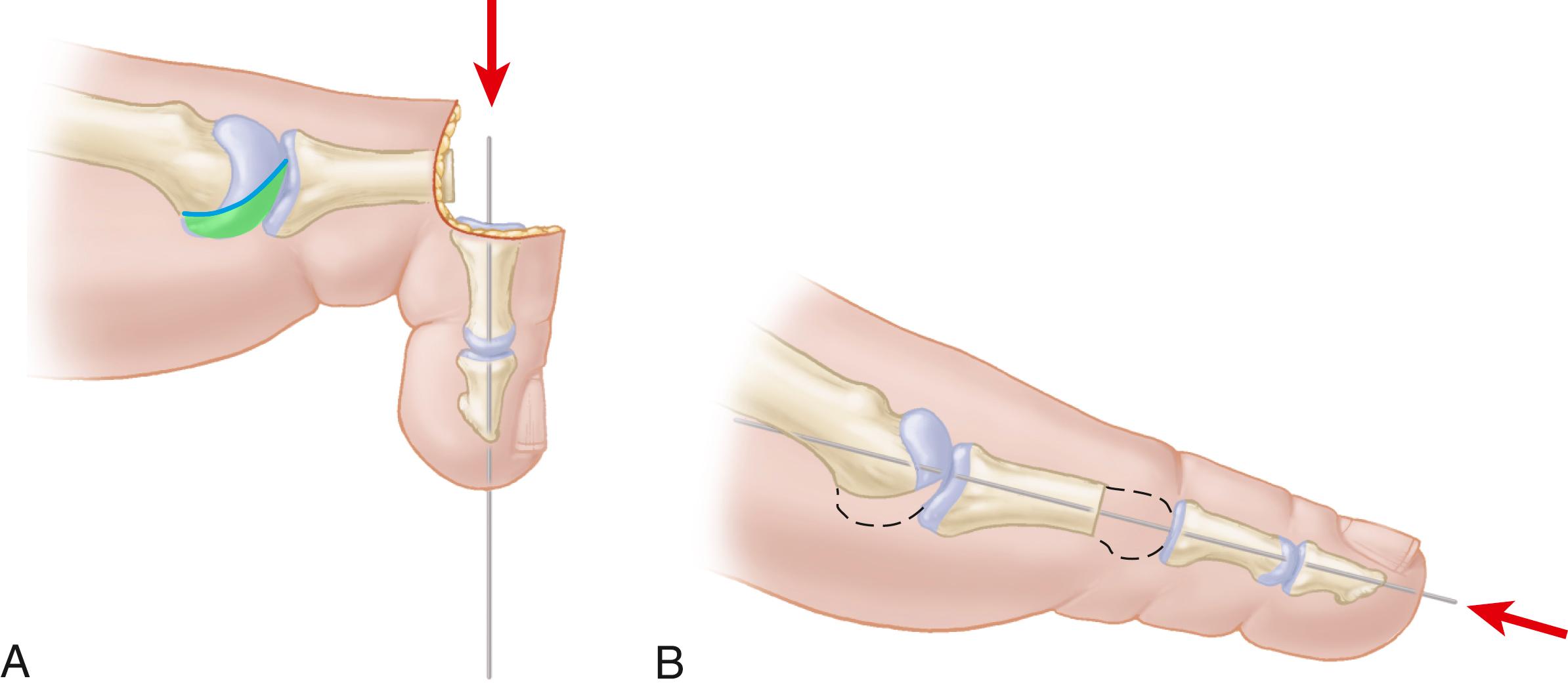 FIGURE 84.29, Pinning of metatarsophalangeal joint after contouring. A, Pin inserted antegrade through middle and distal phalanges. B, Pin reversed and driven retrograde through remaining portion of shaft of phalanx. SEE TECHNIQUE 84.11 .