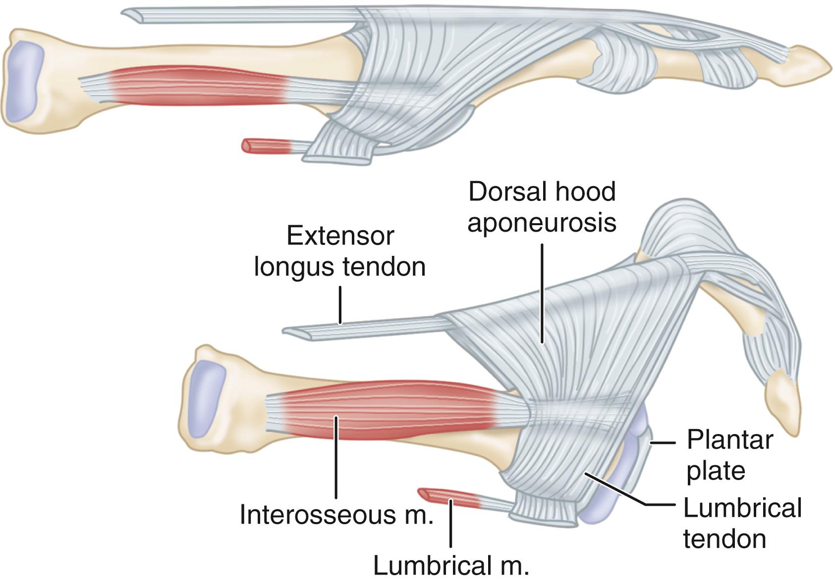 FIGURE 84.3, Anatomy of extrinsic and intrinsic musculature of metatarsophalangeal joint.