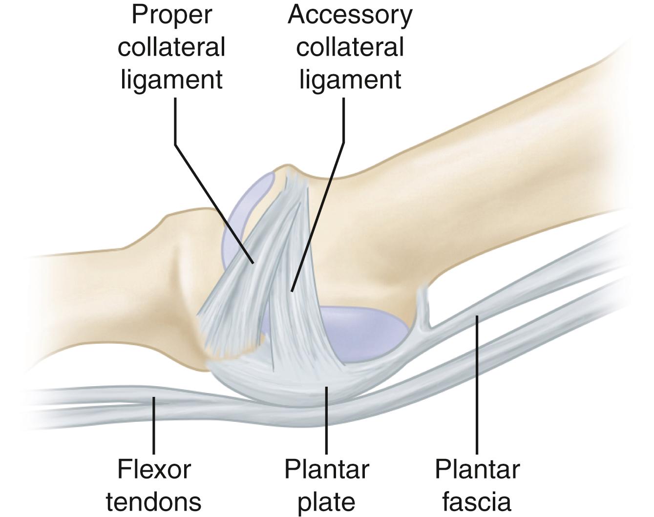 FIGURE 84.4, Location of plantar plate, flexor tendons, and collateral ligaments in relation to metatarsophalangeal joint.