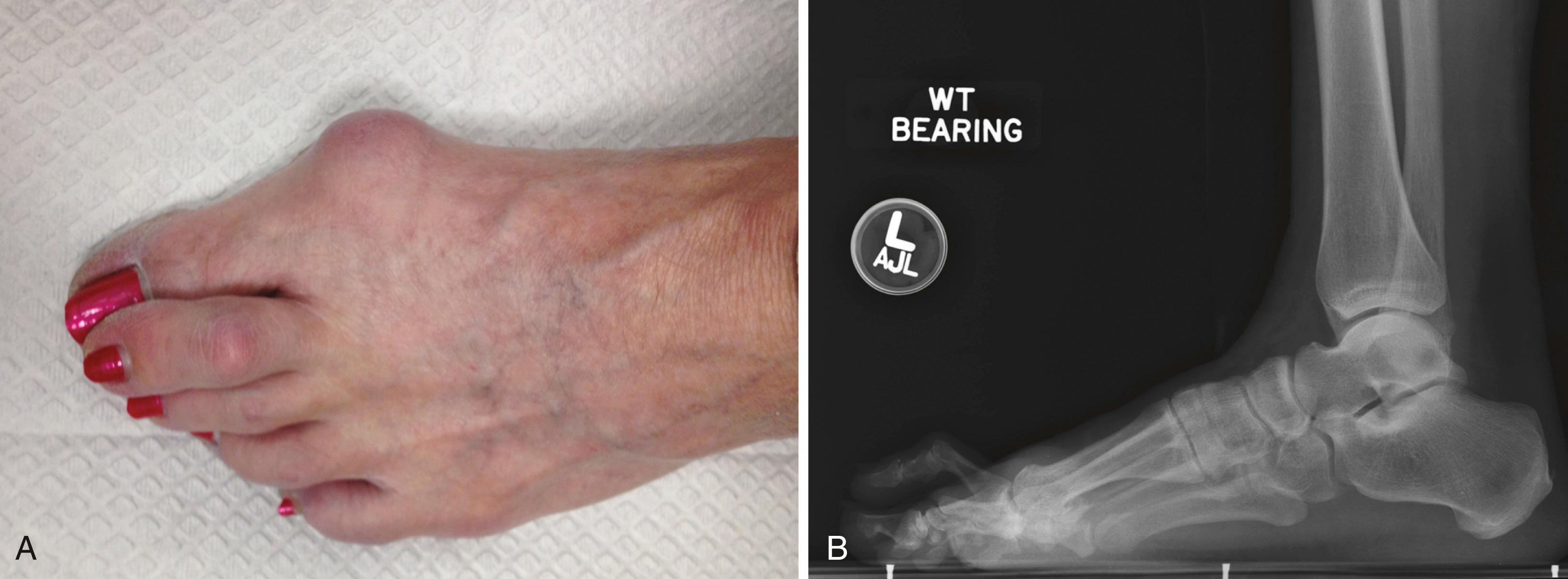 FIGURE 84.5, A and B, Effusion in joint of patient with hammer toe deformity.
