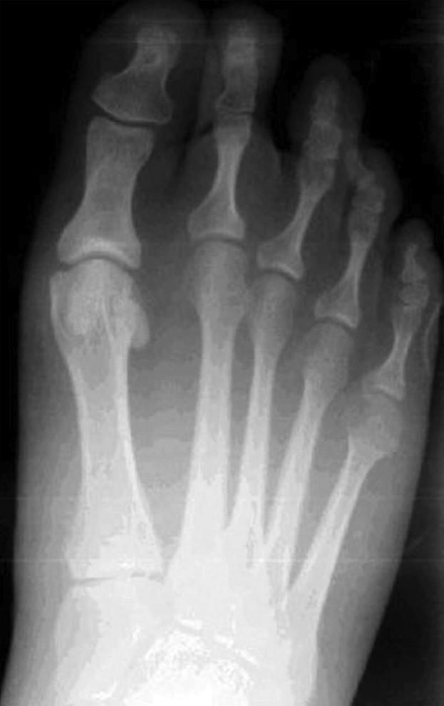 FIGURE 84.6, High-grade tear of second metatarsophalangeal joint plantar plate in patient with deviation of third metatarsophalangeal joint.