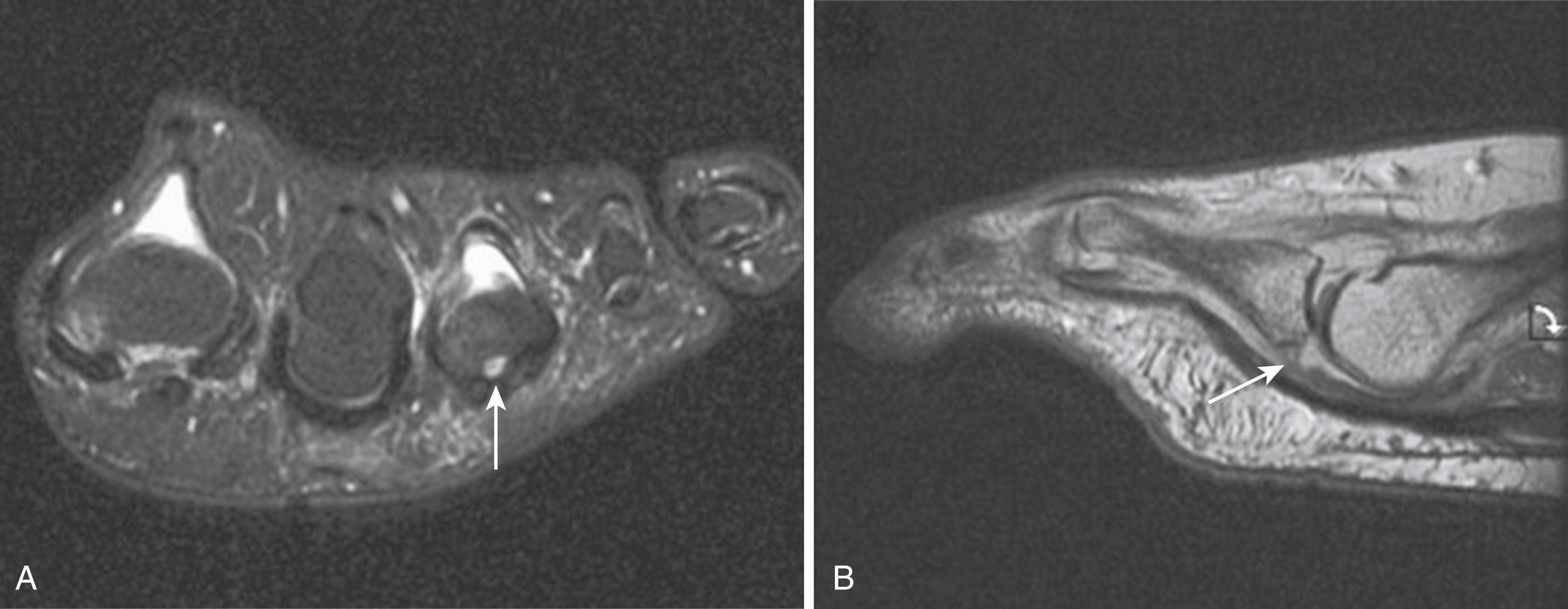 FIGURE 84.7, A and B, Small receiver coil used for MRI evaluation of instability.