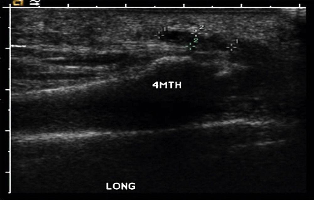 FIGURE 84.8, Appearance of plantar plate tear on ultrasound.