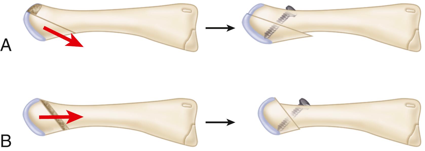 FIGURE 84.10, A and B, Segmental osteotomy for correction of metatarsophalangeal instability (see text).