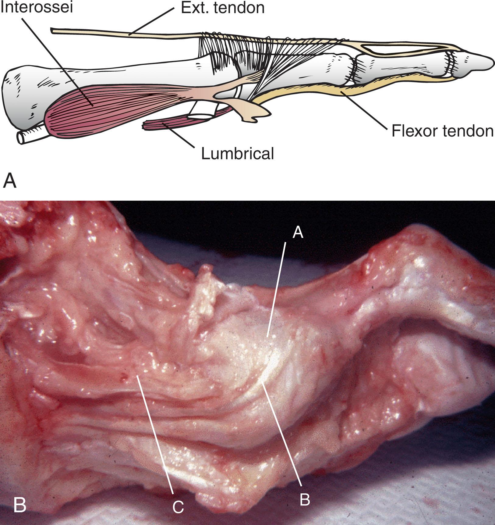 Fig. 9-12, A , Lateral aspect of a lesser toe with portion of the extensor hood removed to demonstrate insertion of the interossei into the base of the proximal phalanx. This insertion permits the interossei to plantar flex the proximal phalanx on the metatarsal head. B , Anatomic dissection demonstrating extensor hood and intrinsics. A , central axis of metatarsophalangeal joint; B , lumbrical; C , interossei.