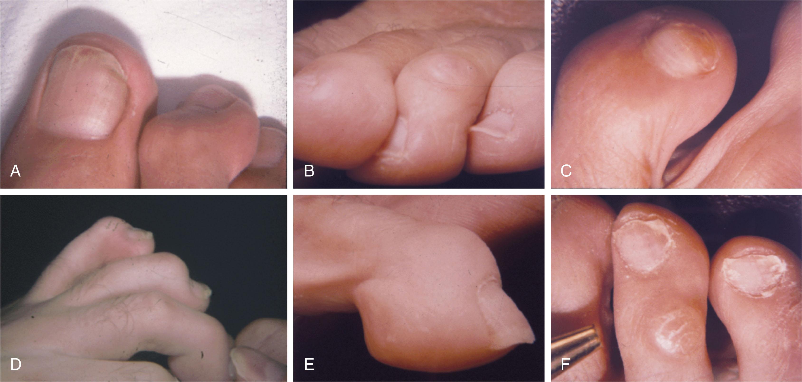 Fig. 9-19, Types of mallet toe deformities. A , Plantar flexion and lateral deviation lead to overlapping of the third toe. B , Mallet toe deformity of the third toe leads to underlapping of the second toe. C , Curvature of the third toe impinges against the adjacent digit in the interspace. D , Multiple mallet toe deformities. E , Plantar flexion contracture of classic mallet toe. F , Callus formation on the dorsal aspect of the distal interphalangeal joint.