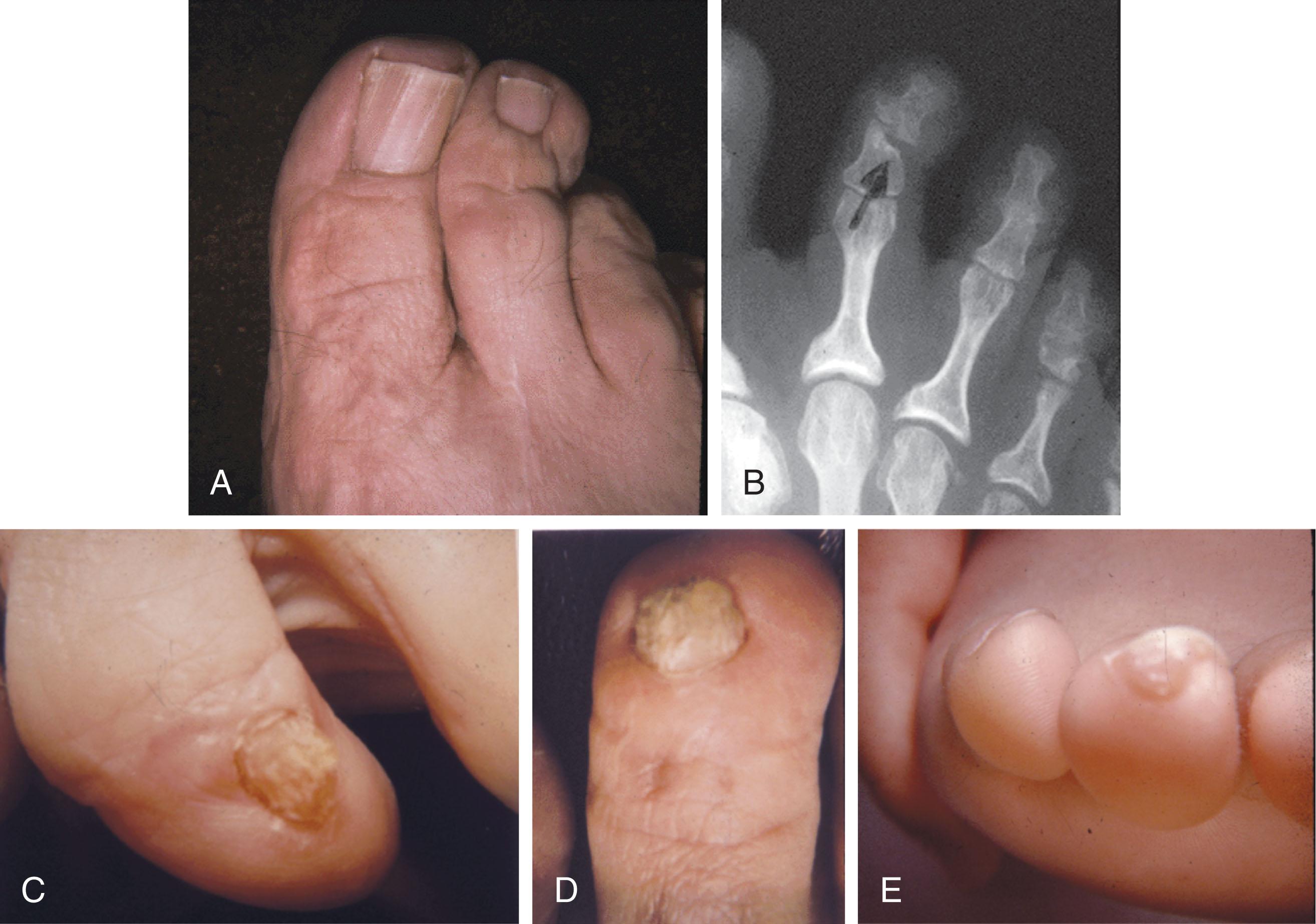 Fig. 9-20, A , Molding of the toe after mallet toe repair. B , Lateral deviation after repair. C and D , Toenail deformity that preceded mallet toe repair does not improve after surgery. E , Callus at tip of toe usually resolves with time after surgical realignment.