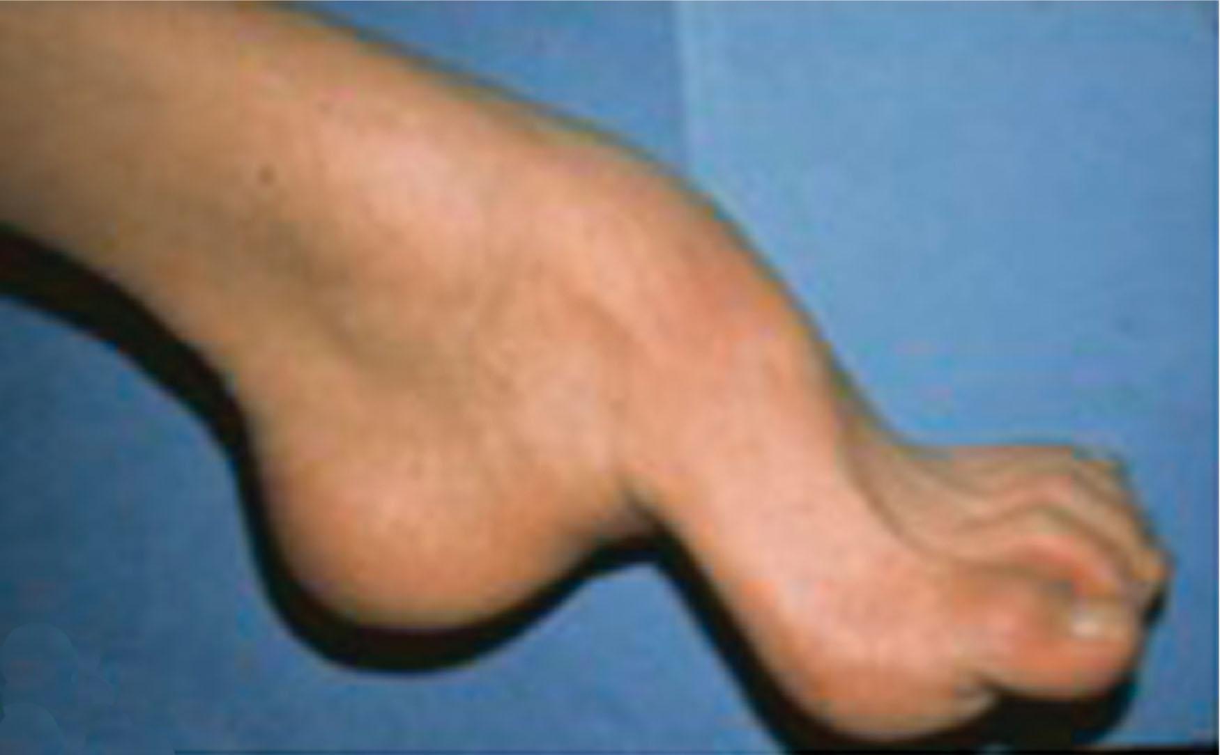 Fig. 9-24, Lateral view of foot with claw toe deformities with an underlying diagnosis of Charcot-Marie-Tooth disease.