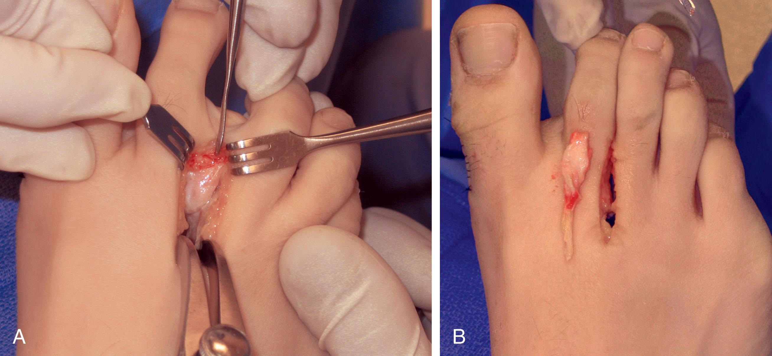 Fig. 9-26, The diagnosis of combined metatarsophalangeal instability and an adjacent interdigital neuroma is uncommon and difficult to make. A , Medial deviation of the second toe with exposure of enlarged symptomatic interdigital neuroma. B , After Weil osteotomy to realign the second toe and excision of the interdigital neuroma.