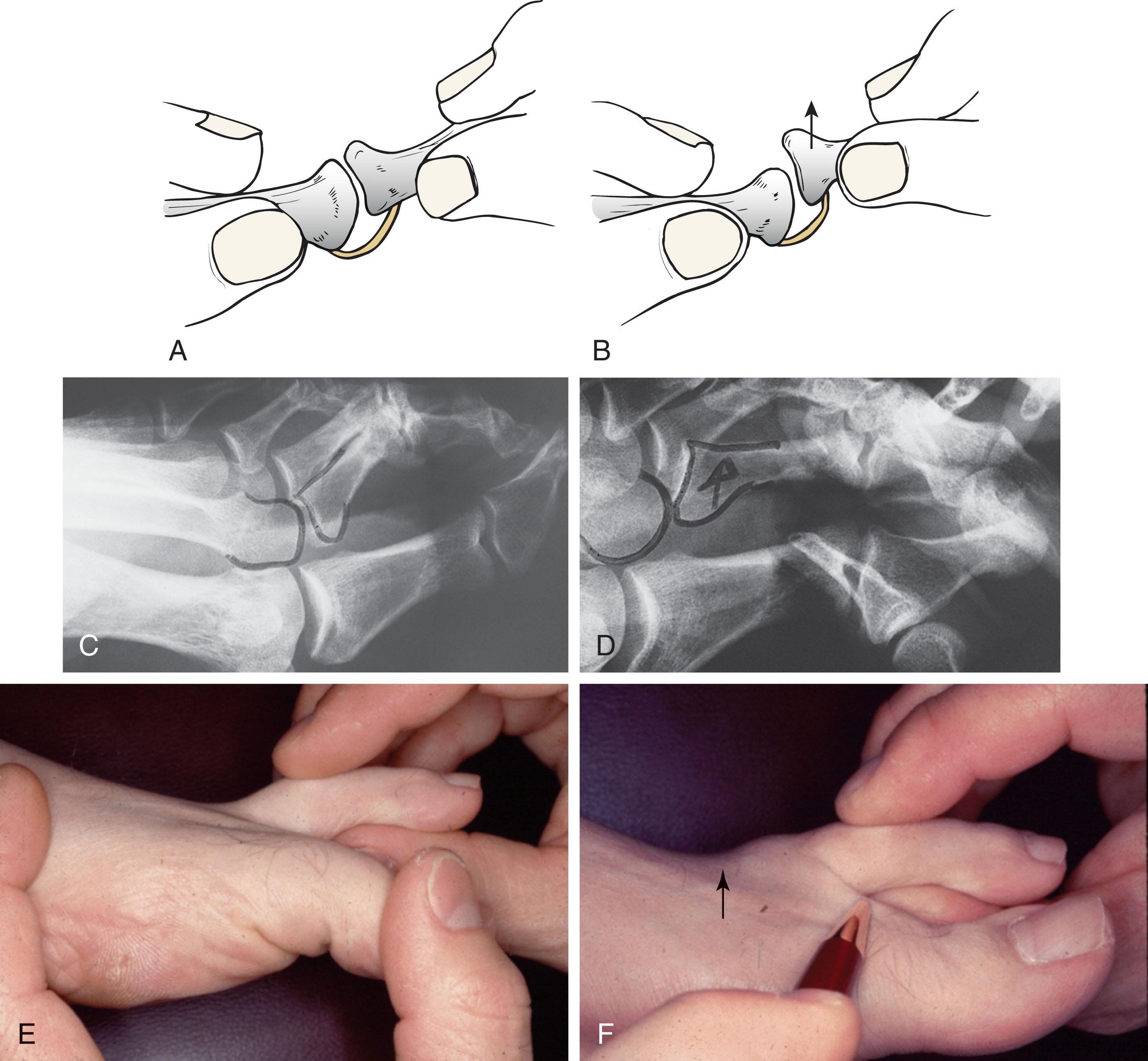 Fig. 9-28, Drawer test for metatarsophalangeal (MTP) joint instability. A , The toe is grasped between the thumb and second finger. B , With dorsal force, an attempt is made to subluxate the MTP joint. With instability of the MTP joint, pain is elicited with stress on the plantar structures. C , Lateral radiograph of unstable second MTP joint before drawer test. D , Lateral radiograph after drawer test with the base of the proximal phalanx subluxated dorsally. E , Before dorsal subluxation of metatarsophalangeal joint with drawer test. F , Position of the base of the toe after dorsal subluxation.