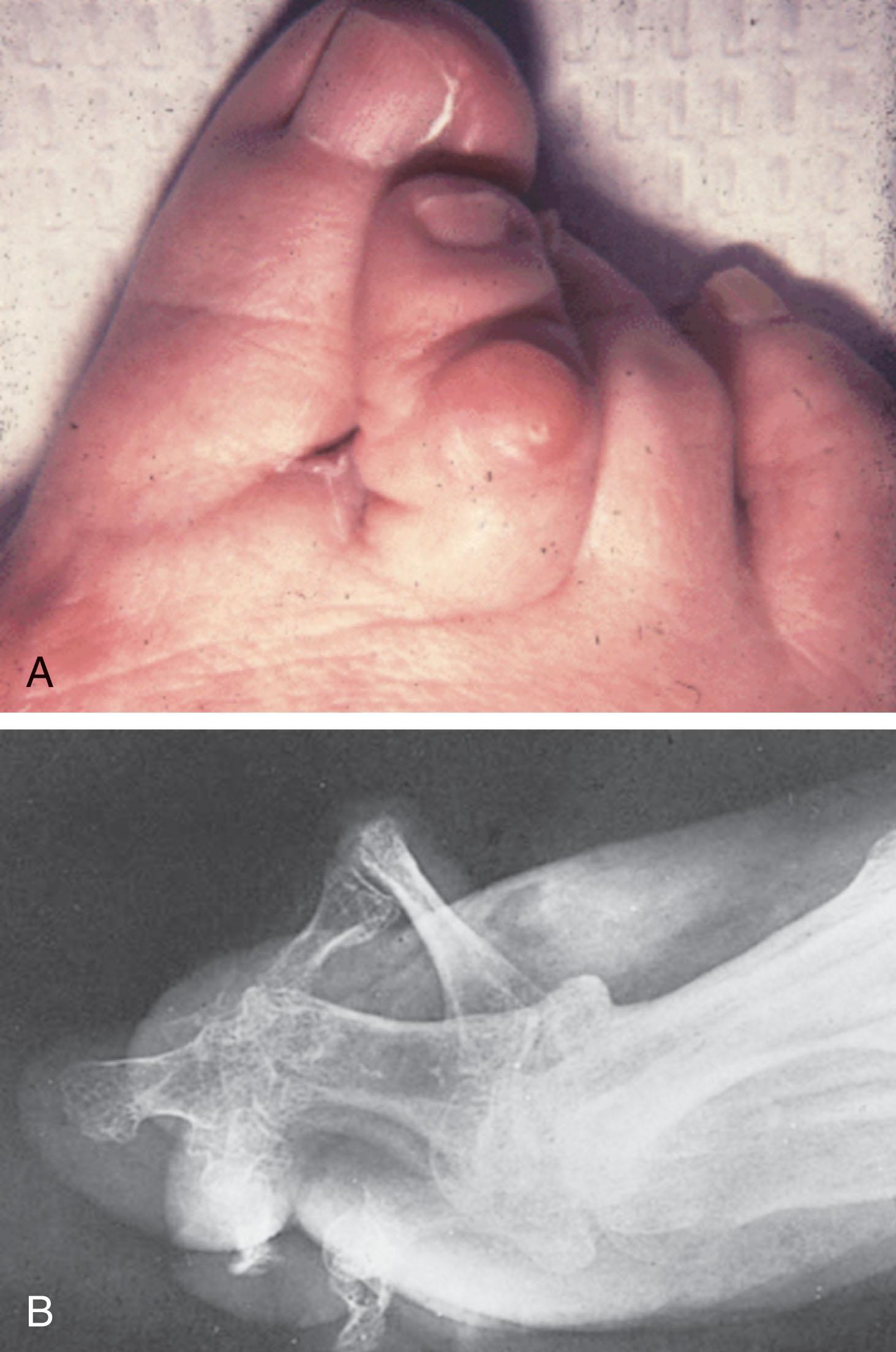 Fig. 9-3, A , Complex hammer toe deformity involving metatarsophalangeal and proximal interphalangeal (PIP) joints of the second toe. B , Lateral radiograph demonstrating severe flexion deformity of PIP joint.