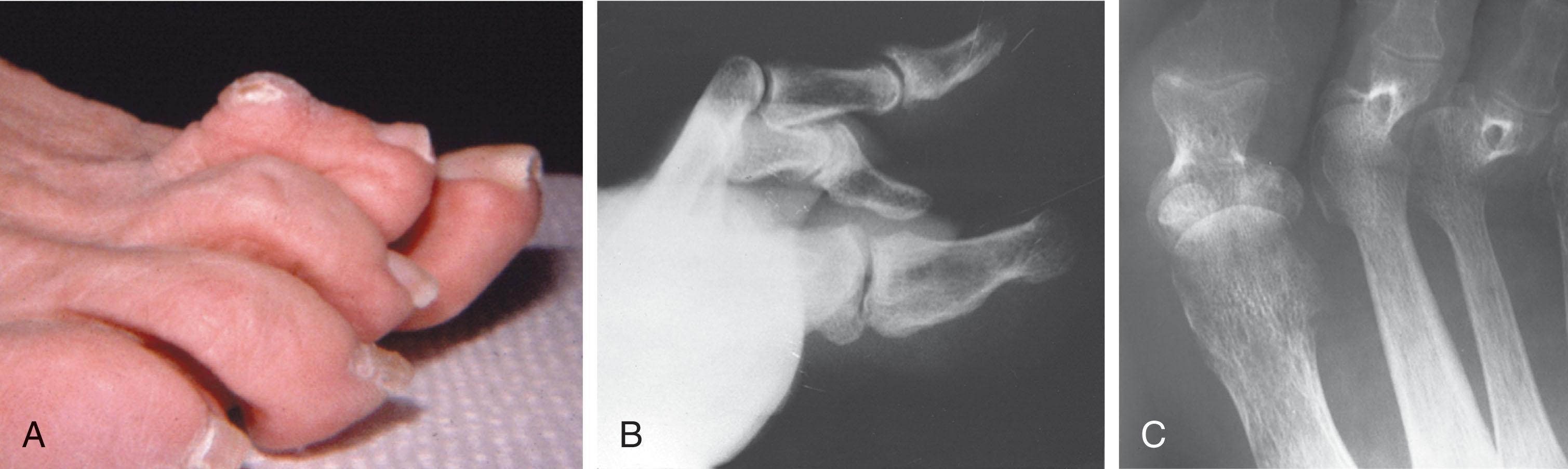 Fig. 9-30, A , Hammer toe deformity demonstrates severe hyperextension. B , Lateral radiograph demonstrates hyperextension deformity of the proximal phalanx. C , Anteroposterior radiograph demonstrates the gun barrel sign. The proximal phalanx is seen end on, superimposed over the condyle. This conformation is pathognomonic of hyperextension deformity of the proximal phalanx.
