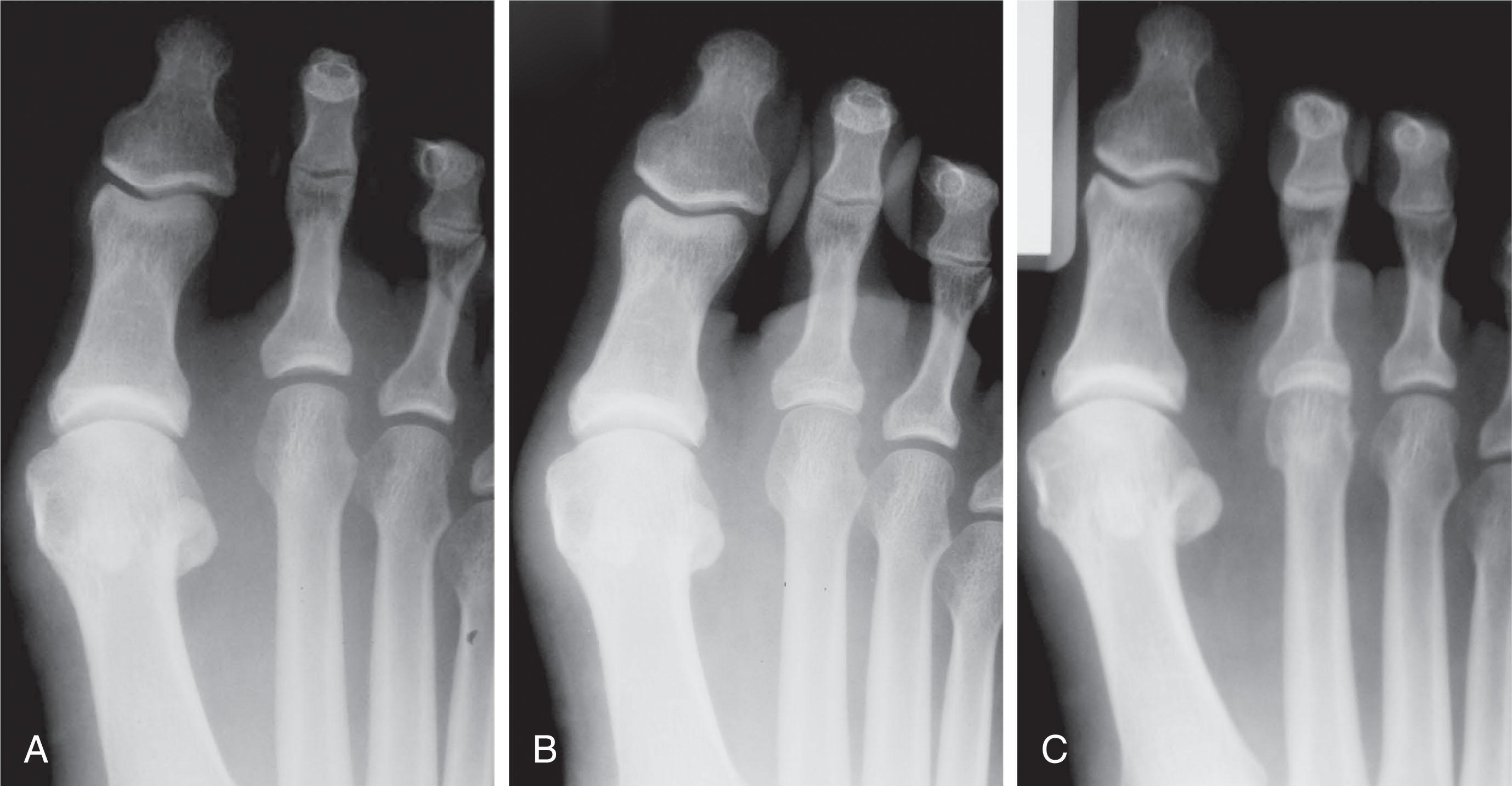 Fig. 9-31, A , A 52-year-old man with pain at the second metatarsophalangeal (MTP) joint and a slight hallux valgus deformity. B , Six-month follow-up demonstrates narrowing of the joint space, pathognomonic of a hyperextension deformity. Often subluxation can occur insidiously. C , At 15-month follow-up, the second MTP joint has dislocated.
