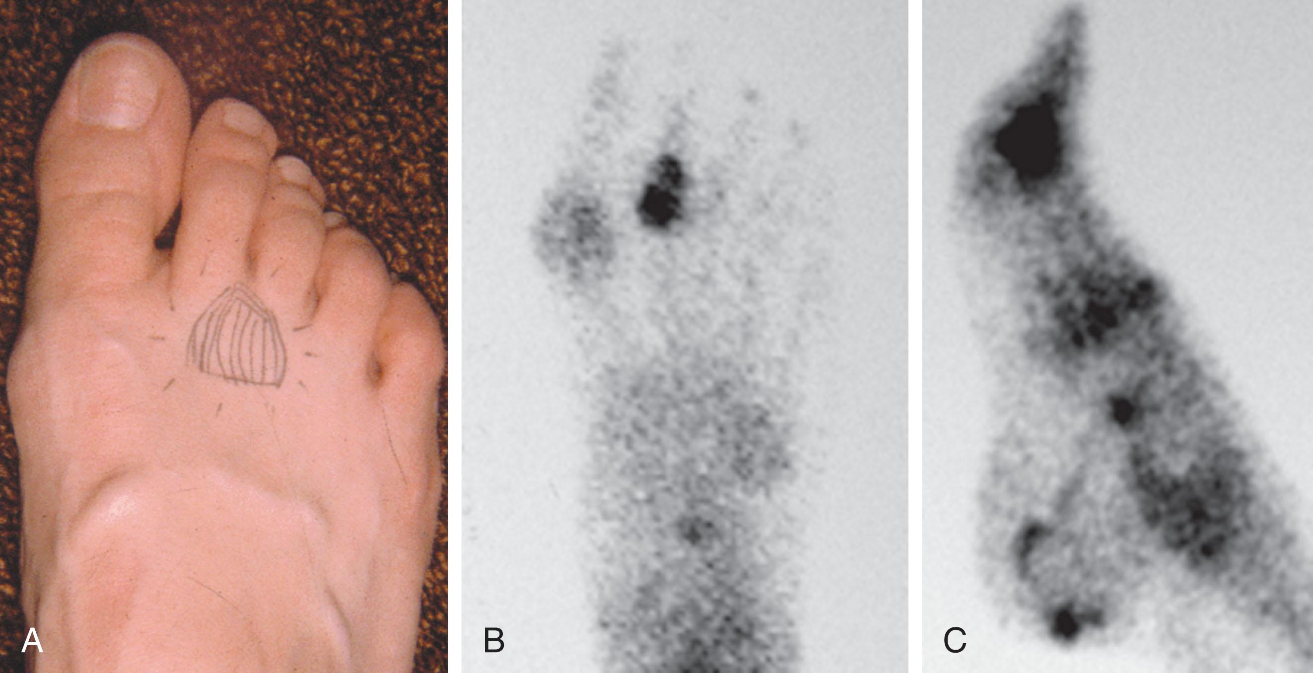 Fig. 9-32, Patient with ill-defined forefoot pain. A , Clinical location of pain. Technetium-99m ( 99m Tc) bone scan, anteroposterior (B) and lateral (C) views, can demonstrate pathologic changes before radiographic changes. Note the increased uptake in the area of the second metatarsophalangeal joint.