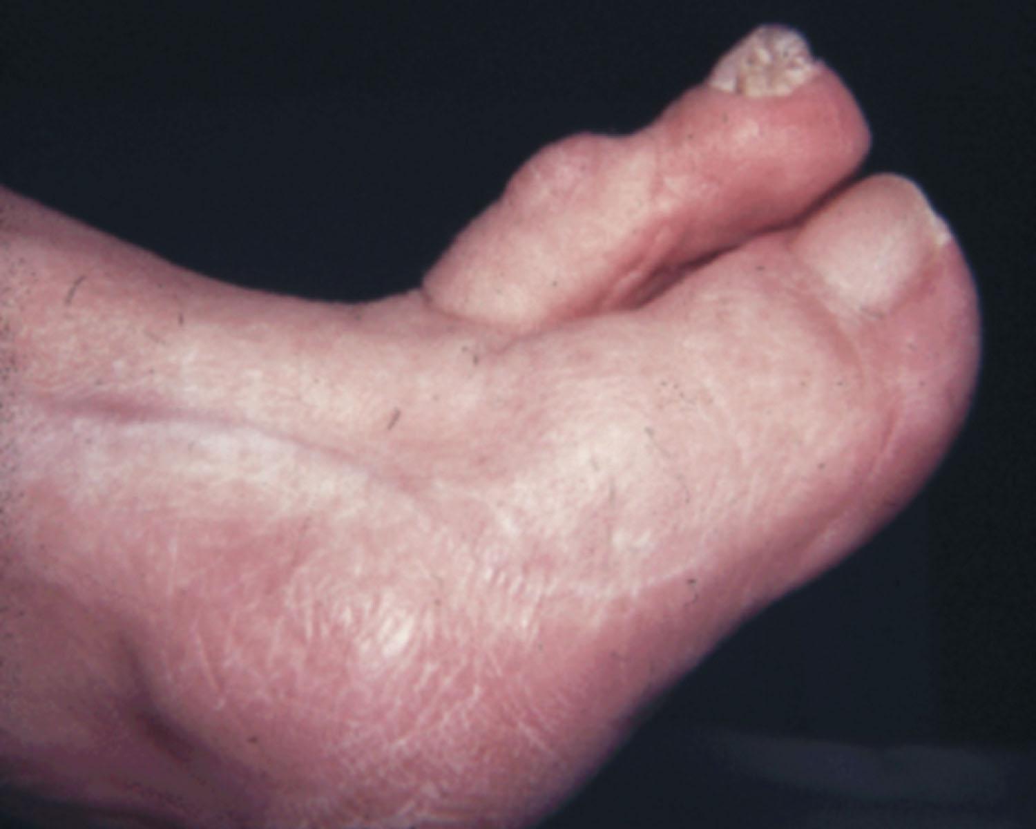 Fig. 9-33, An isolated hammer toe repair or a flexor tenotomy can lead to hyperextension deformity of the involved toe.